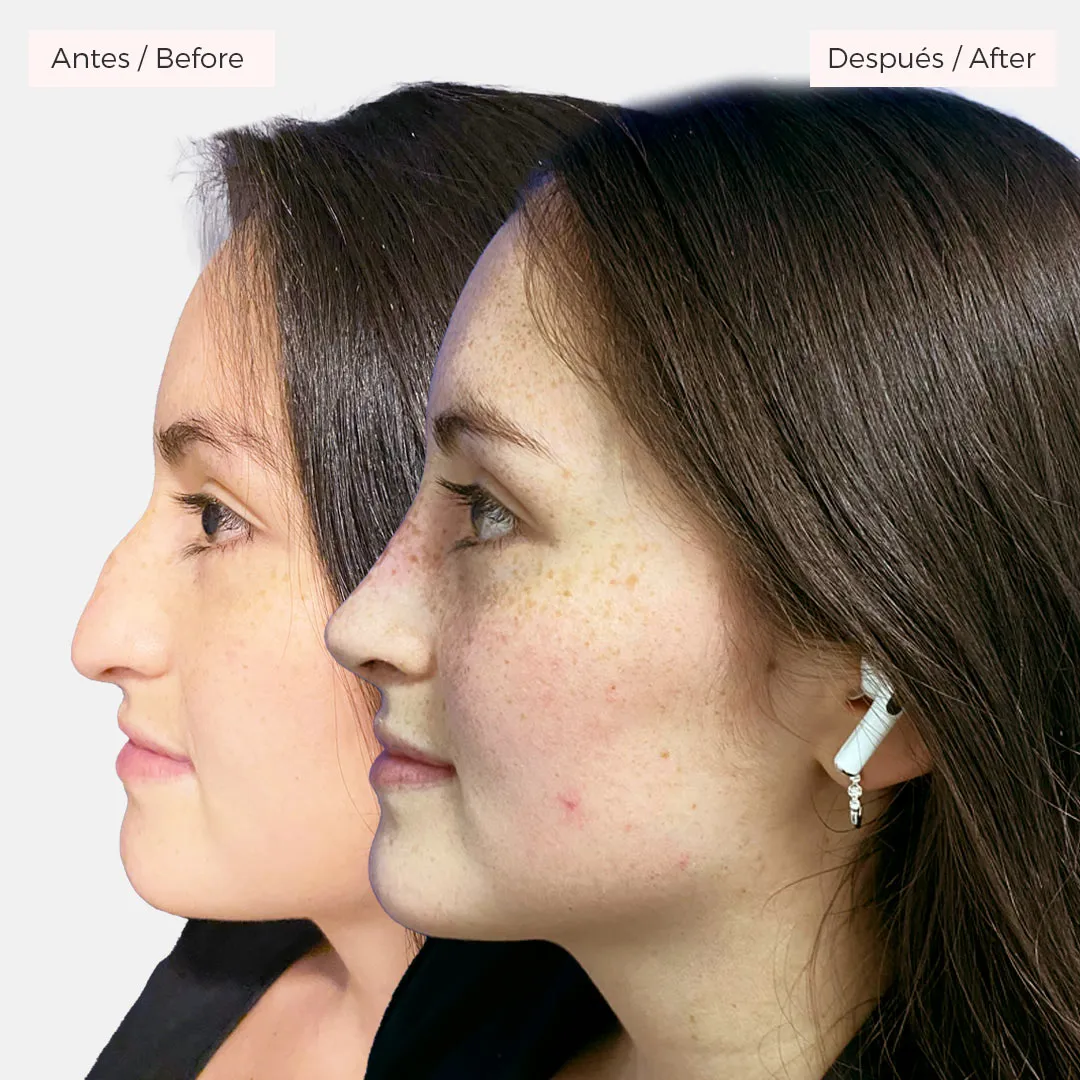 rinoplastia bogotá antes y después