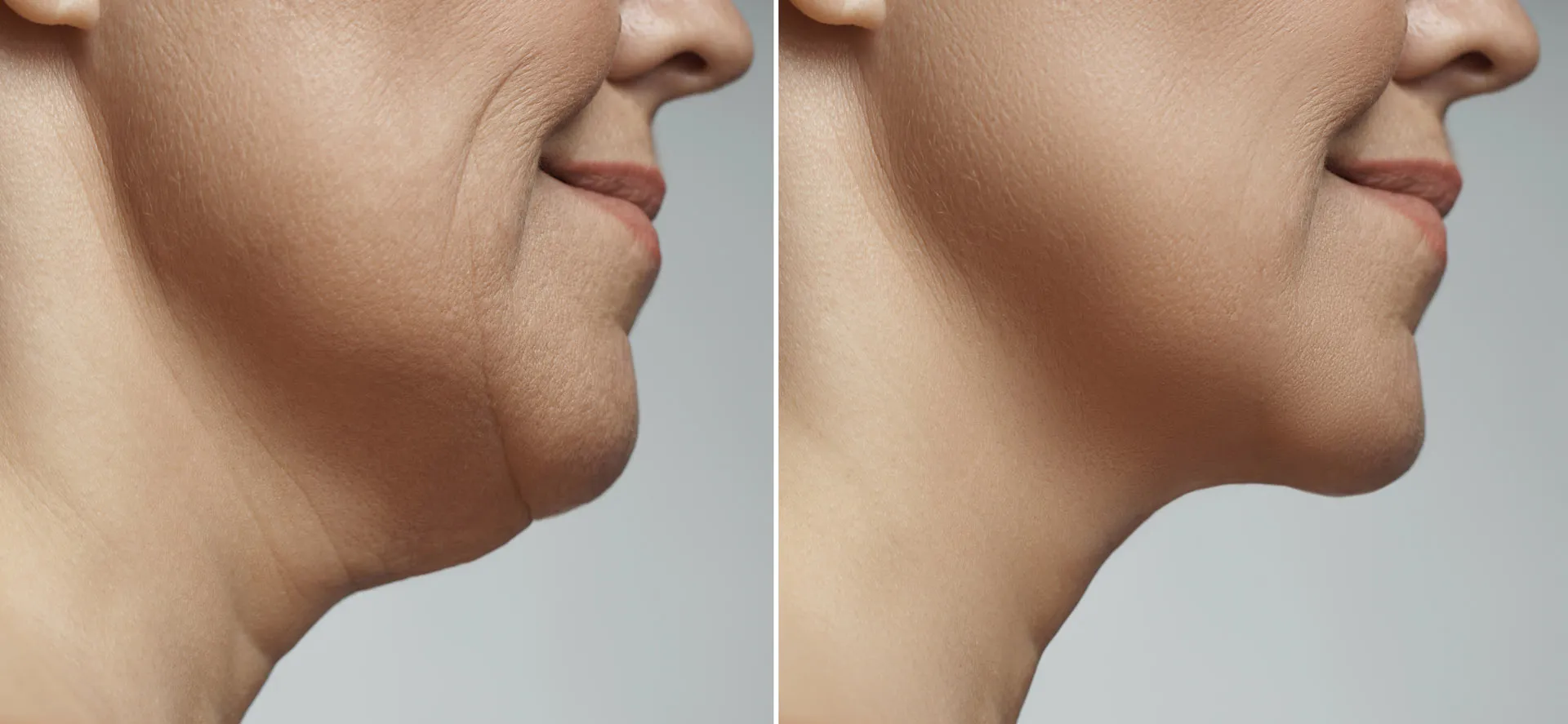 No todo es grasa: lo que debes saber antes de hacerte una lipopapada