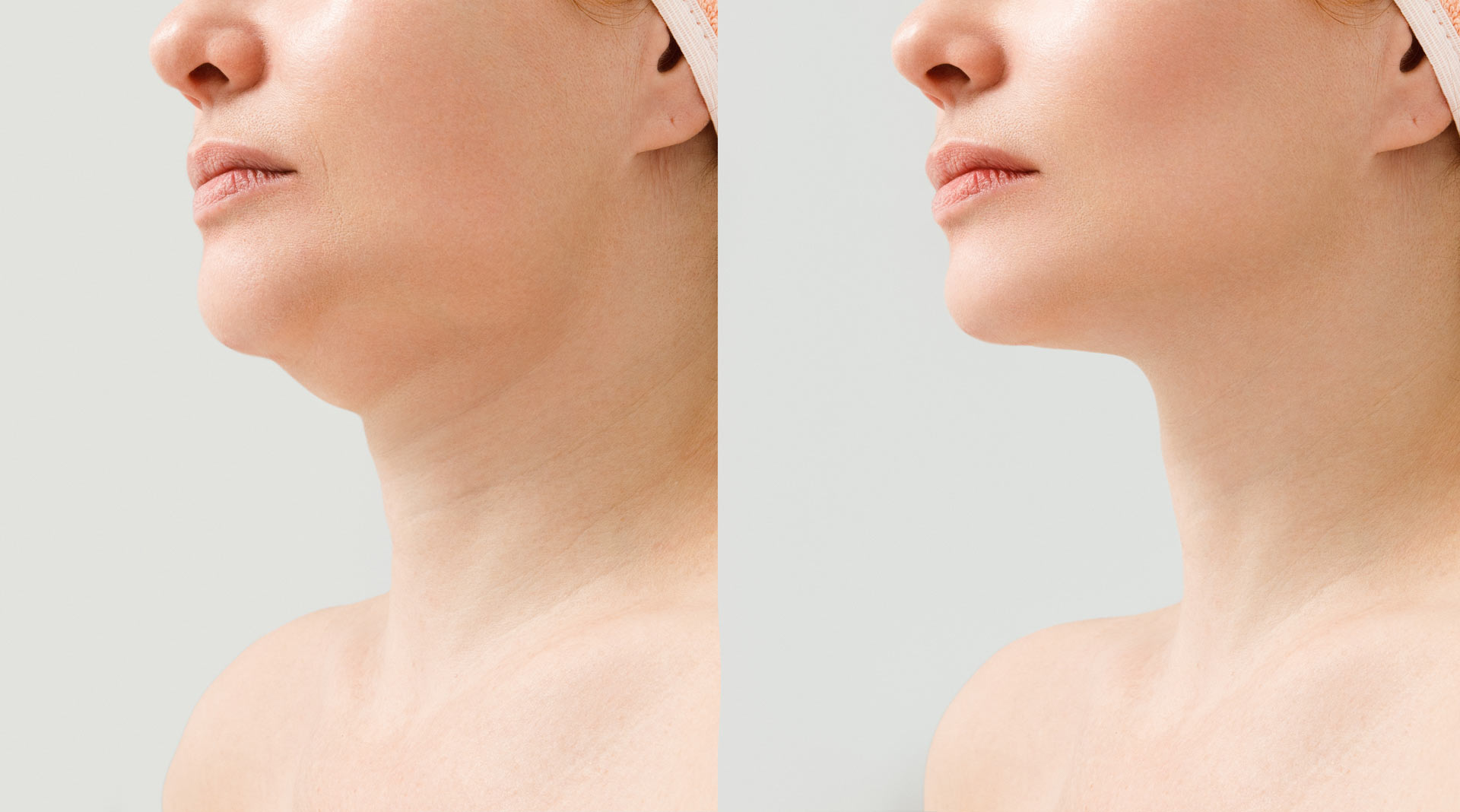 Cuello y papada: cervicoplastia vs. lipopapada, ¿cuál necesitas?