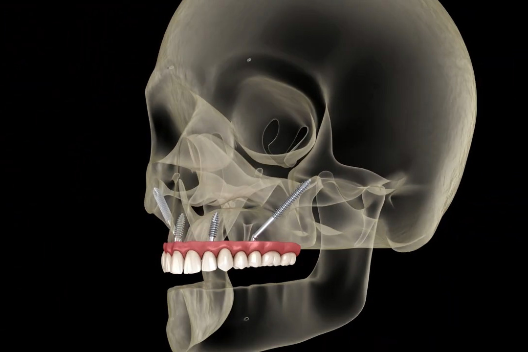 Illustration showing the placement of zygomatic implants anchored to the cheekbone for patients with severe bone loss. / Source: Omer Istanbul Dental Center (EZ Newswire)