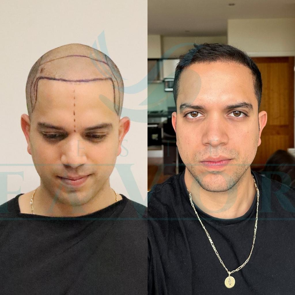 Source: Este Favor Hair Transplant Clinic (EZ Newswire)