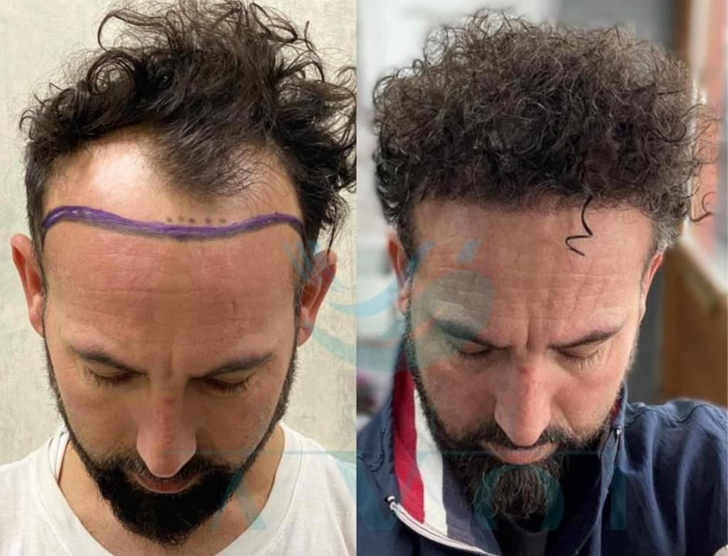 Source: Este Favor Hair Transplant Clinic (EZ Newswire)