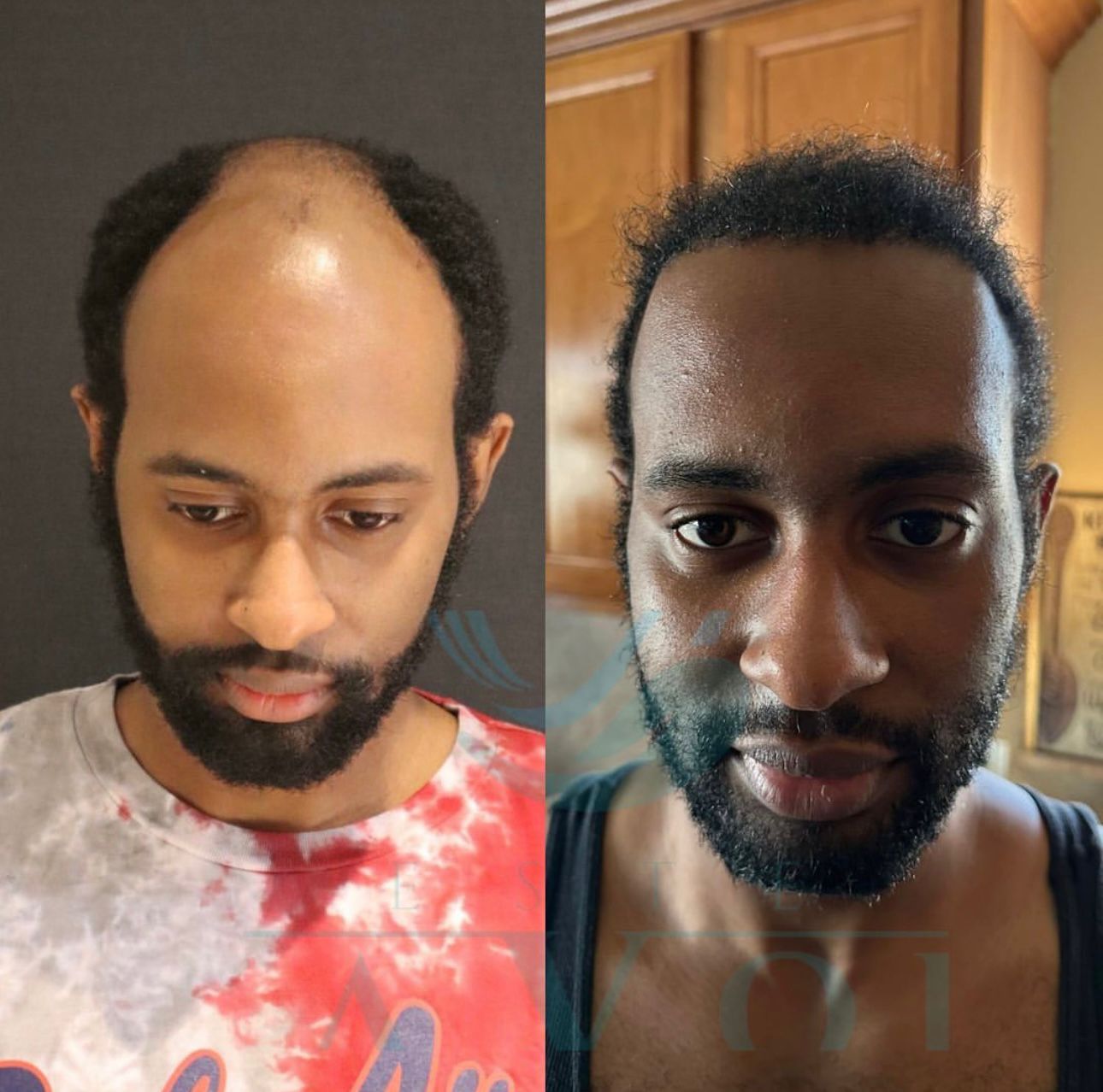 Source: Este Favor Hair Transplant Clinic (EZ Newswire)