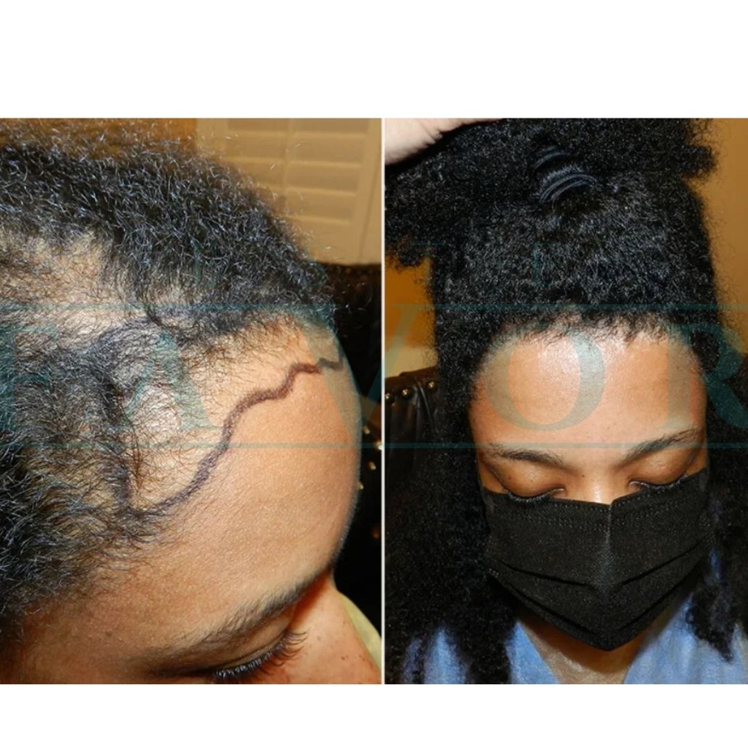 Source: Este Favor Hair Transplant Clinic (EZ Newswire)