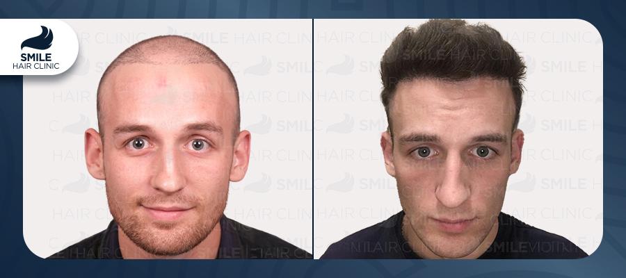 Source: Smile Hair Clinic (EZ Newswire)