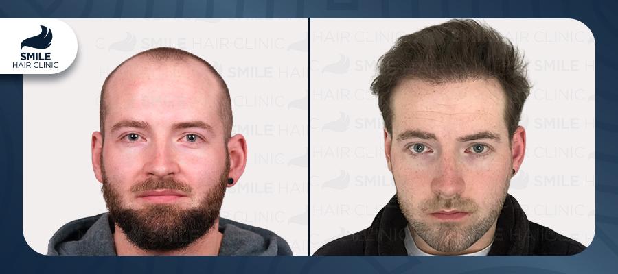 Source: Smile Hair Clinic (EZ Newswire)