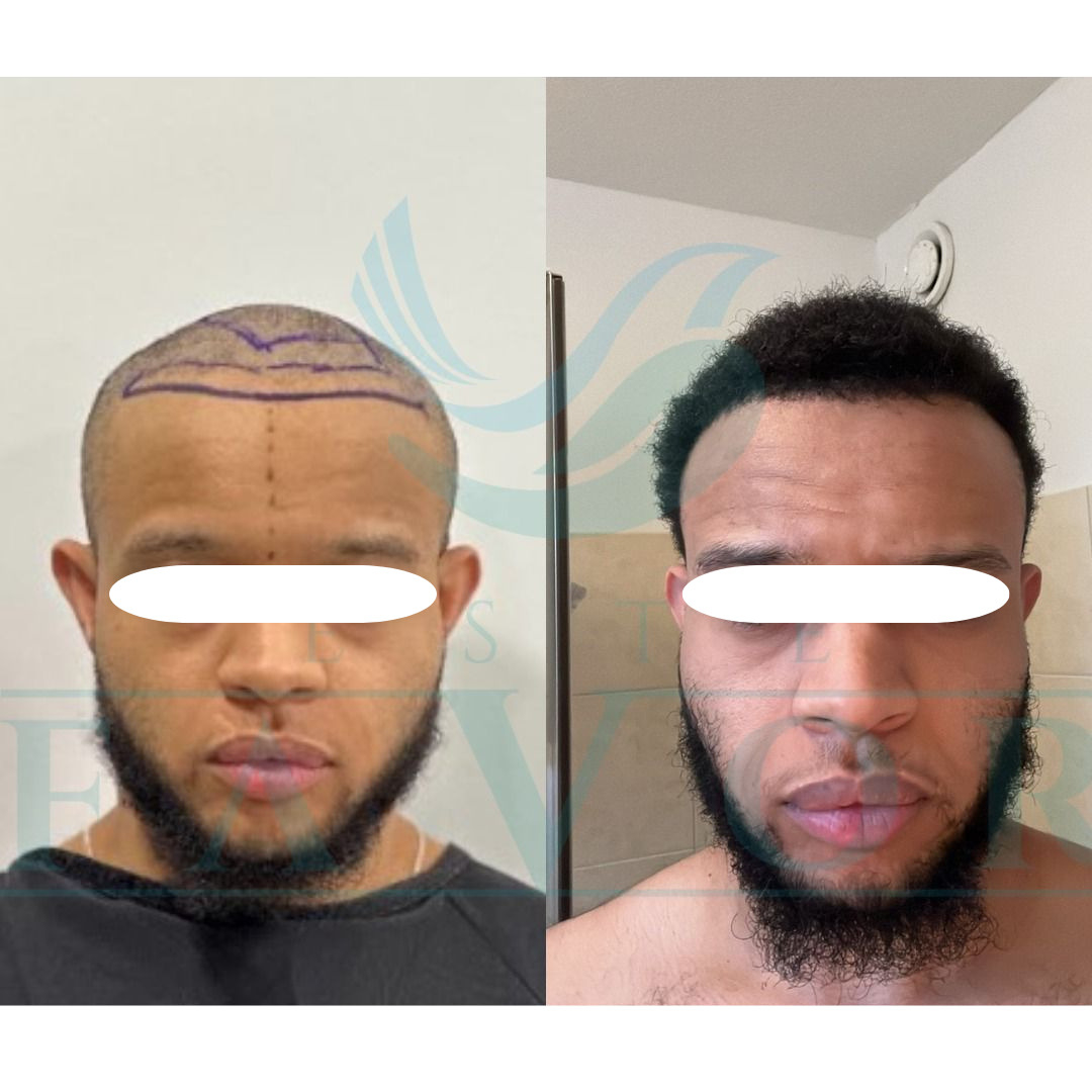 Source: Este Favor Hair Transplant Clinic (EZ Newswire)