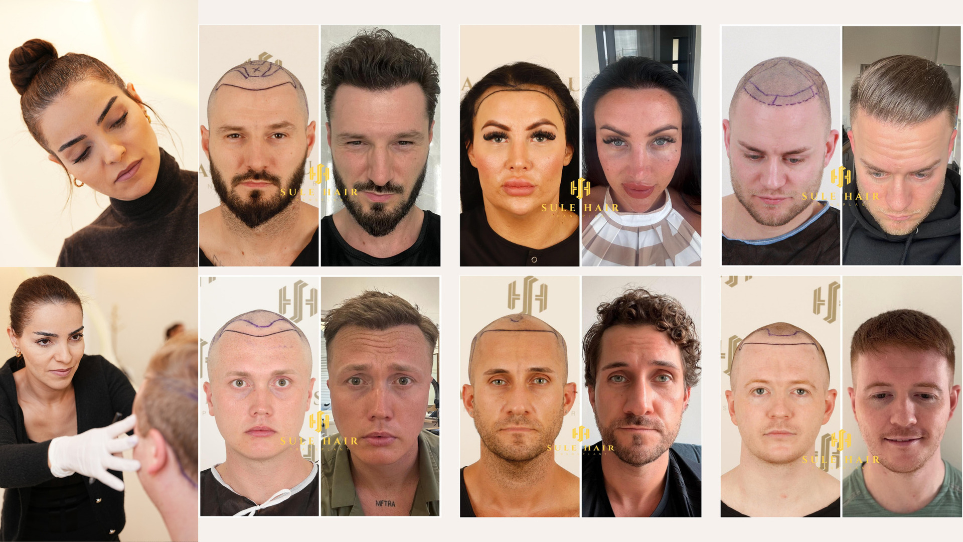 Source: Sule Hair Transplant (EZ Newswire)