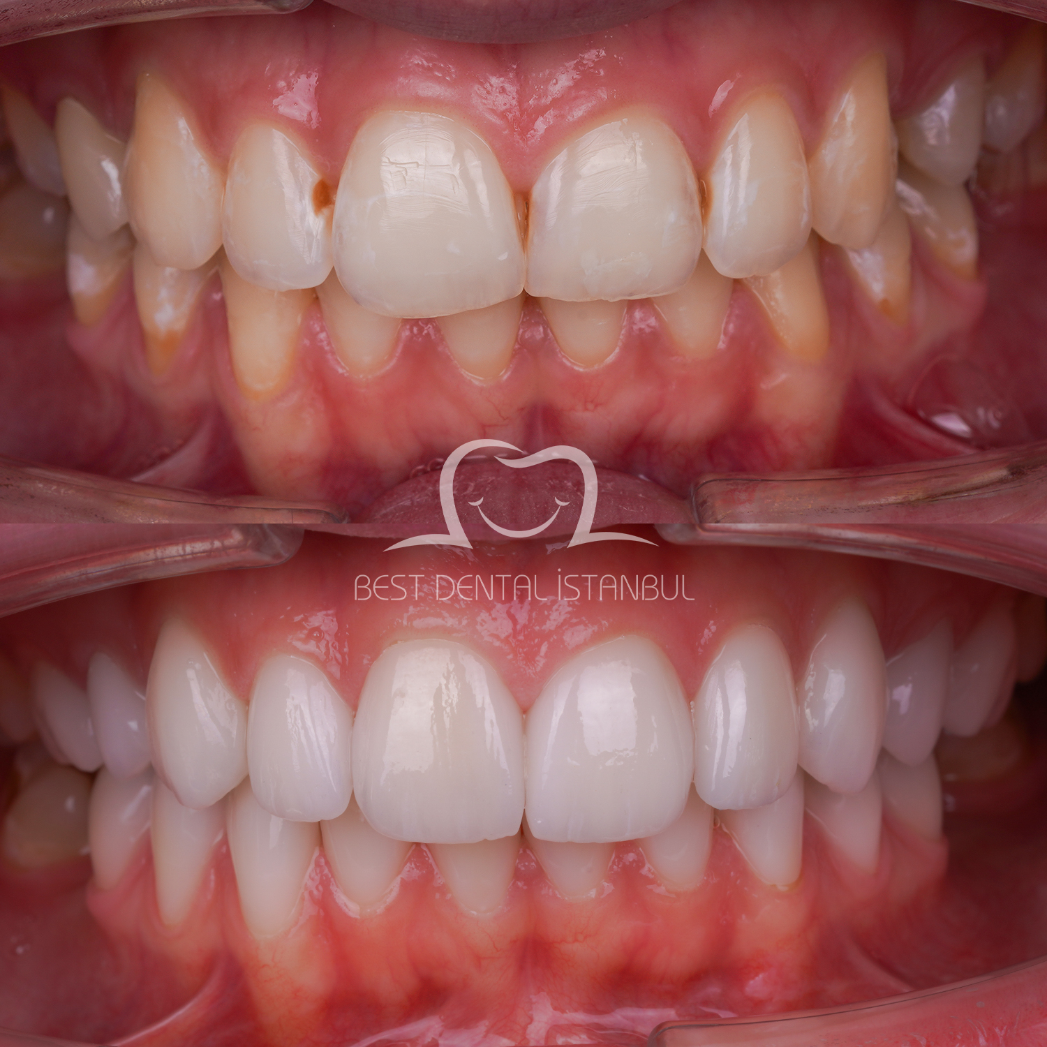 Source: Best Dental İstanbul (EZ Newswire)