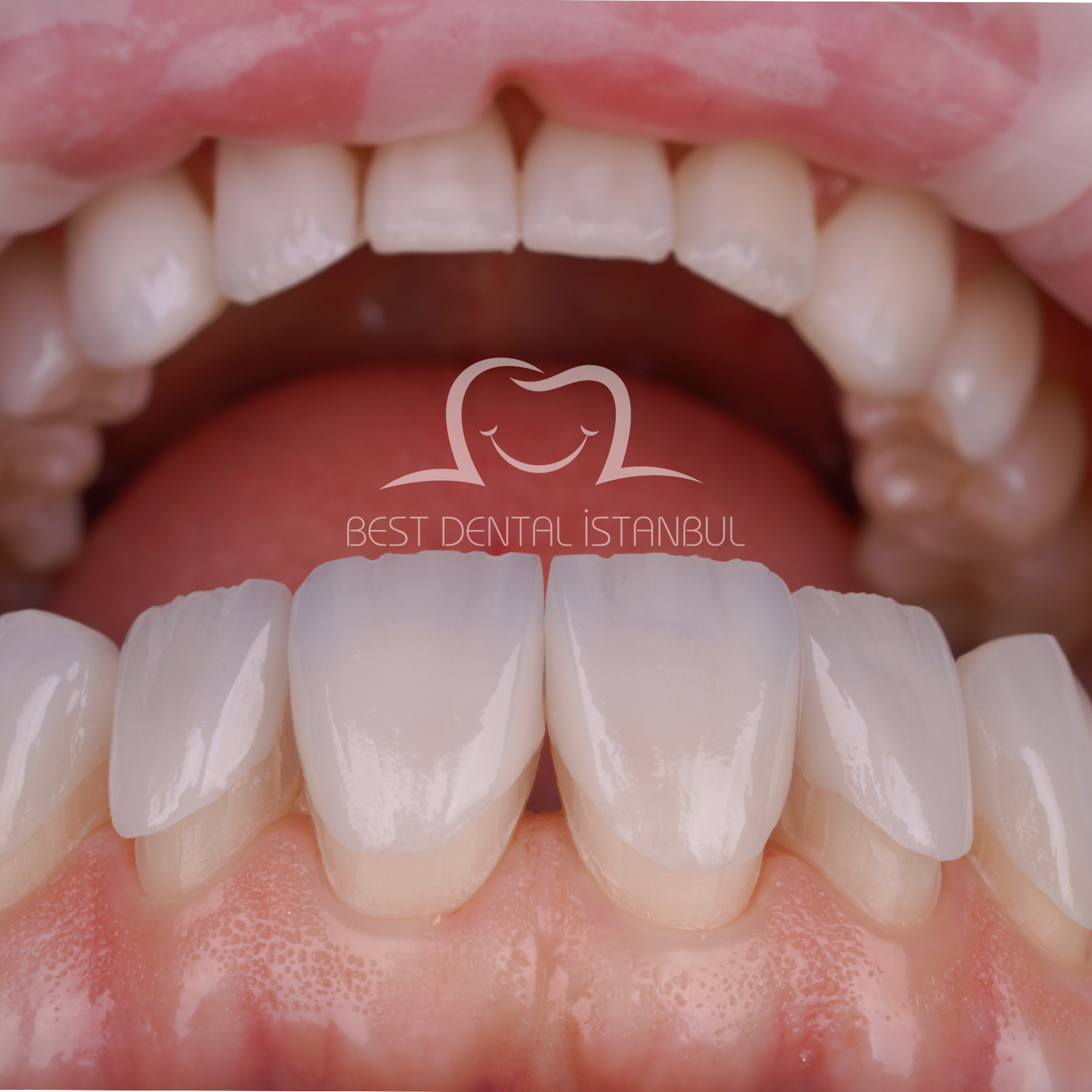 Source: Best Dental İstanbul (EZ Newswire)