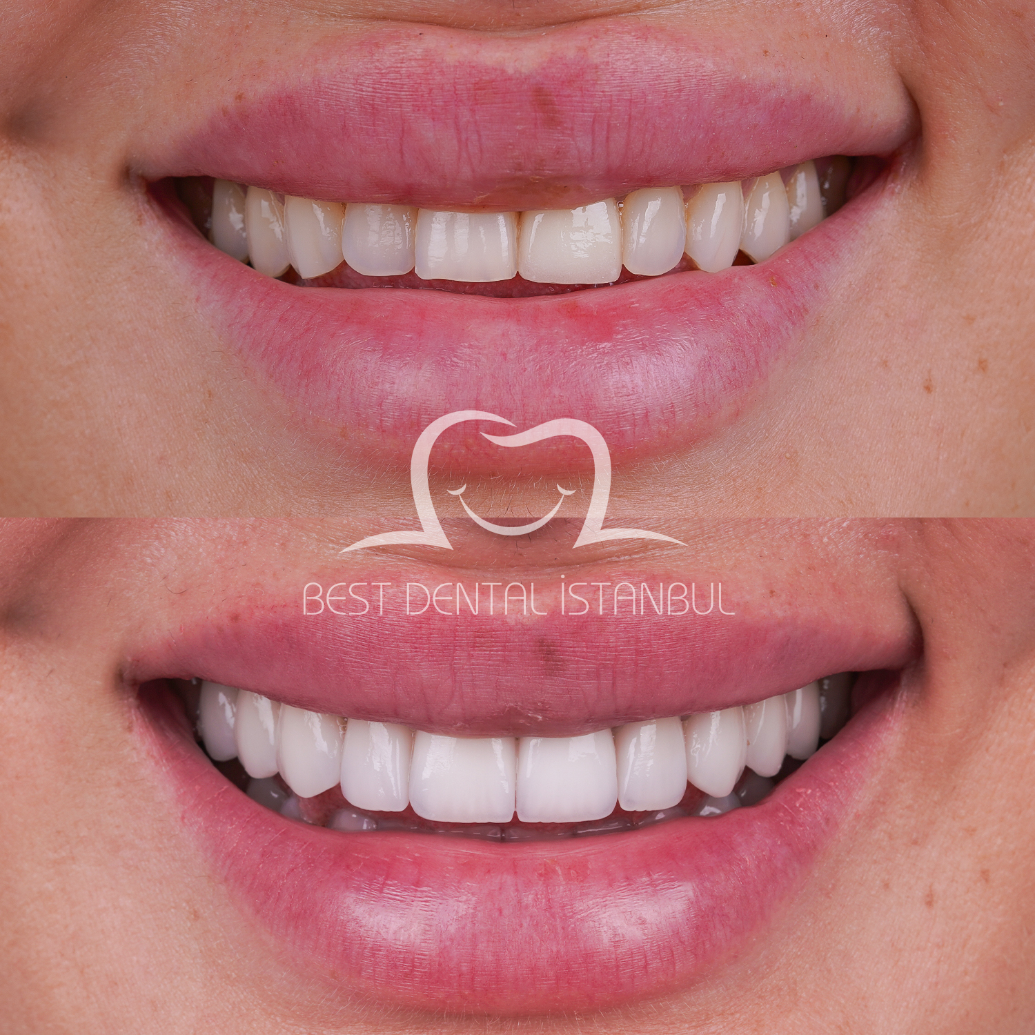 Source: Best Dental İstanbul (EZ Newswire)