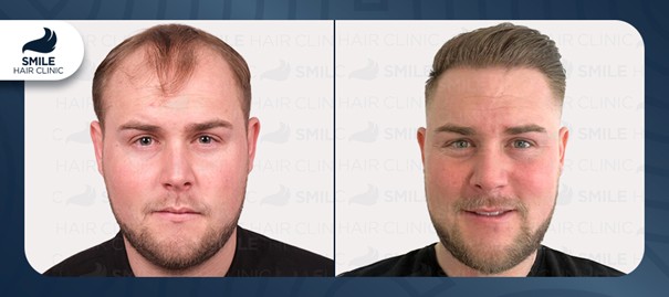 Smile Hair Clinic - Before After Hair Transplant / Source: Crabs Media (EZ Newswire)