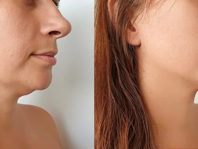 Jawline Filler - Buk Clinic / Source: Crabs Media (EZ Newswire)