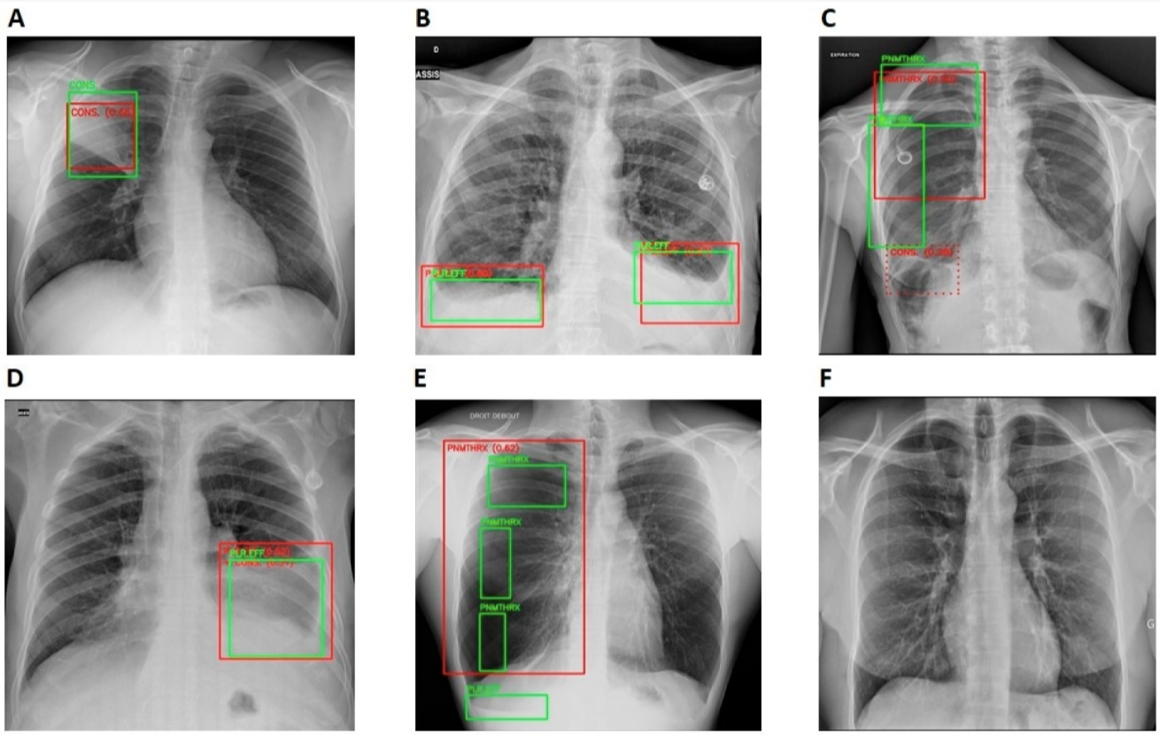 AI in Chest Detection and Care