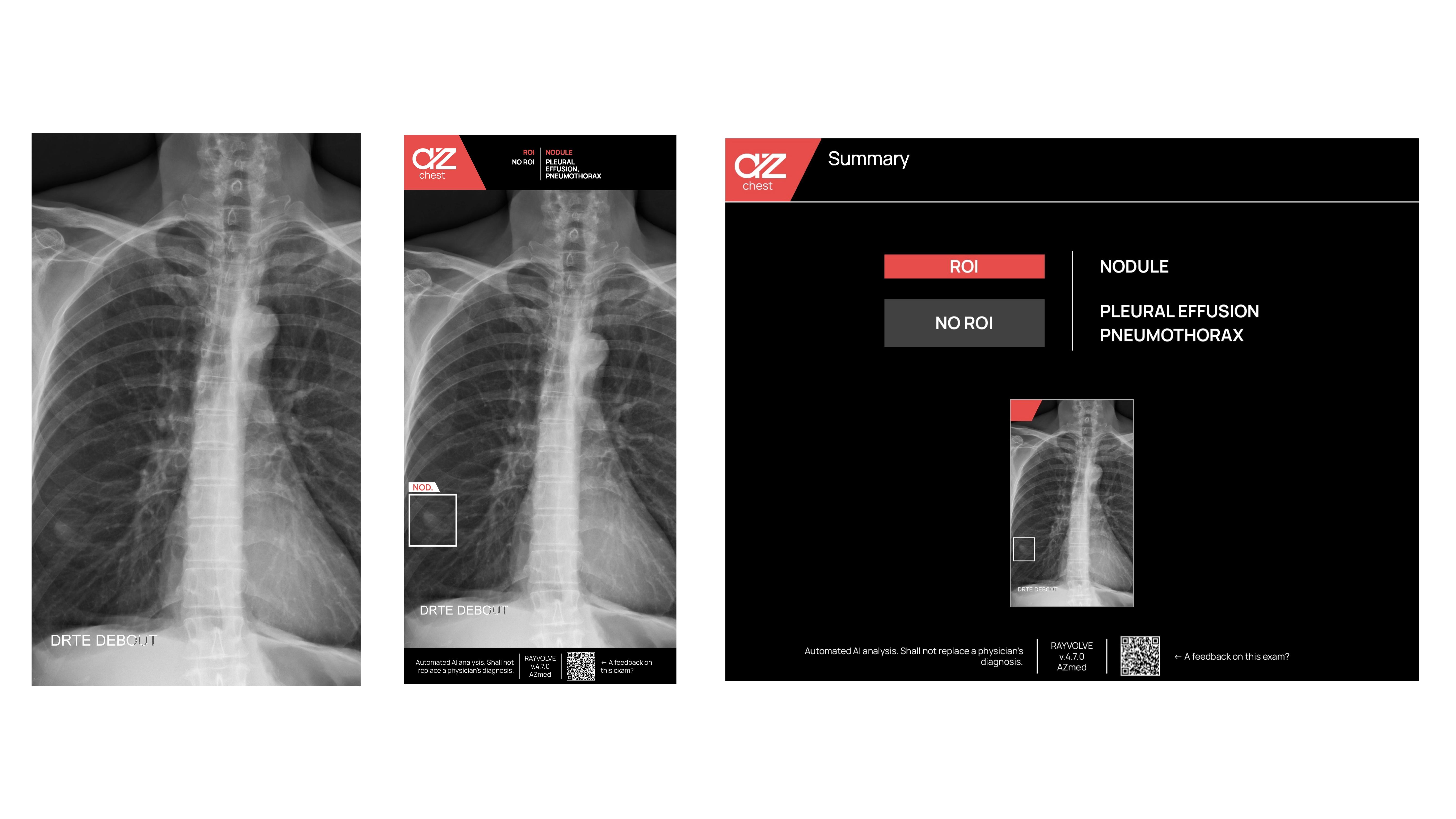 Nodule Cancer Detection with AI