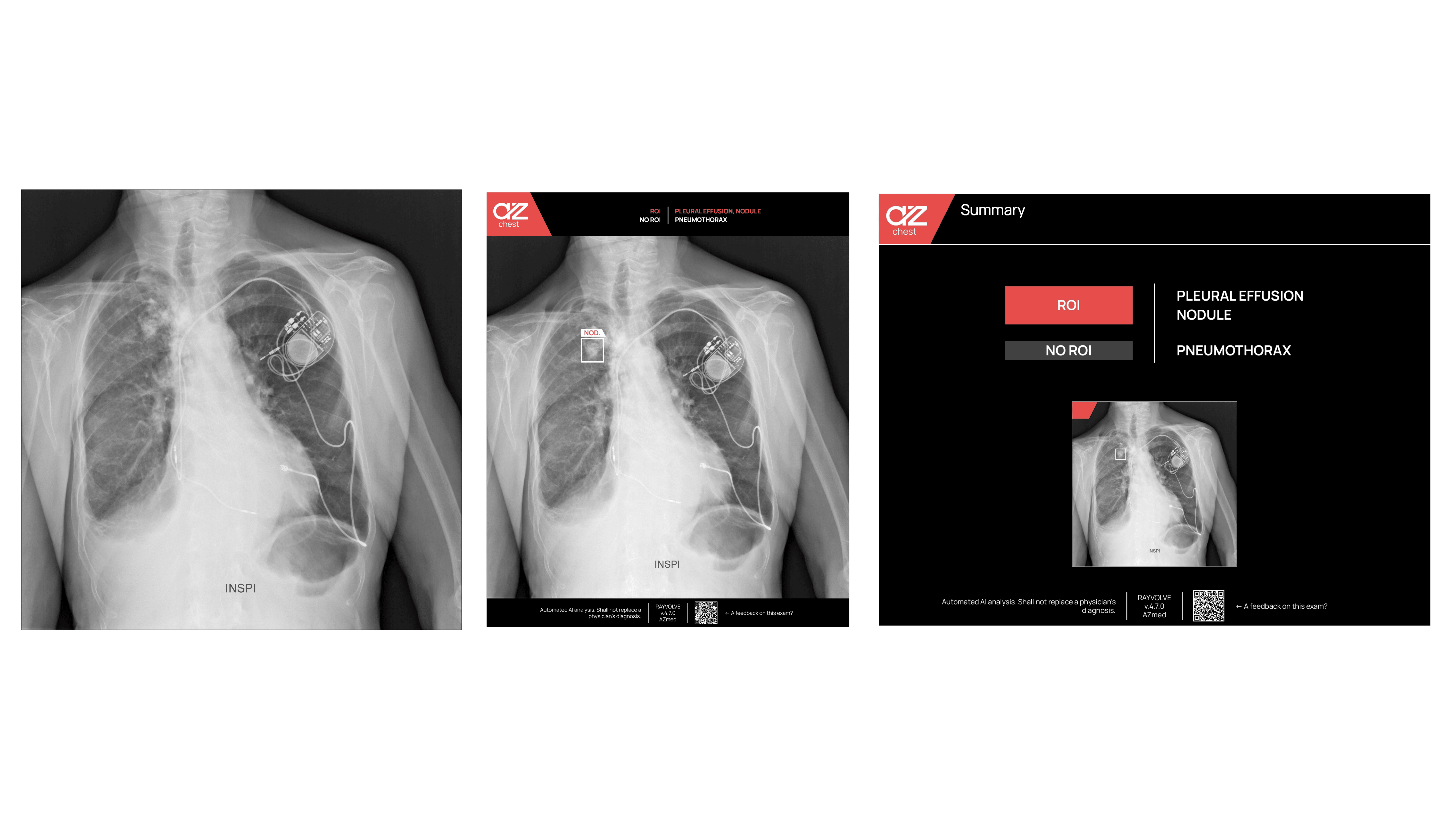 Nodule detection in Chest Radiography with Artificial Intelligence