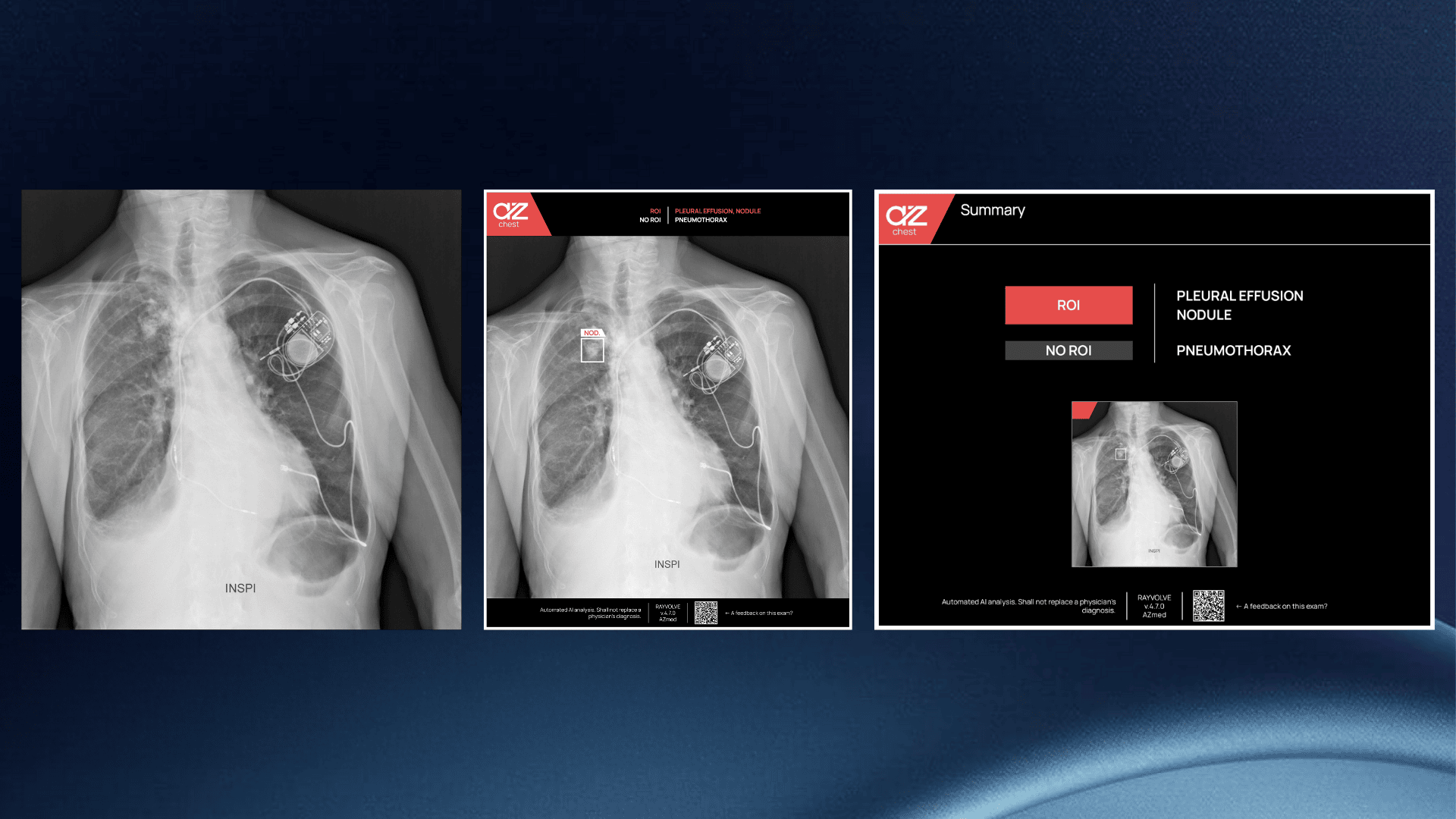 AI in Chest Detection