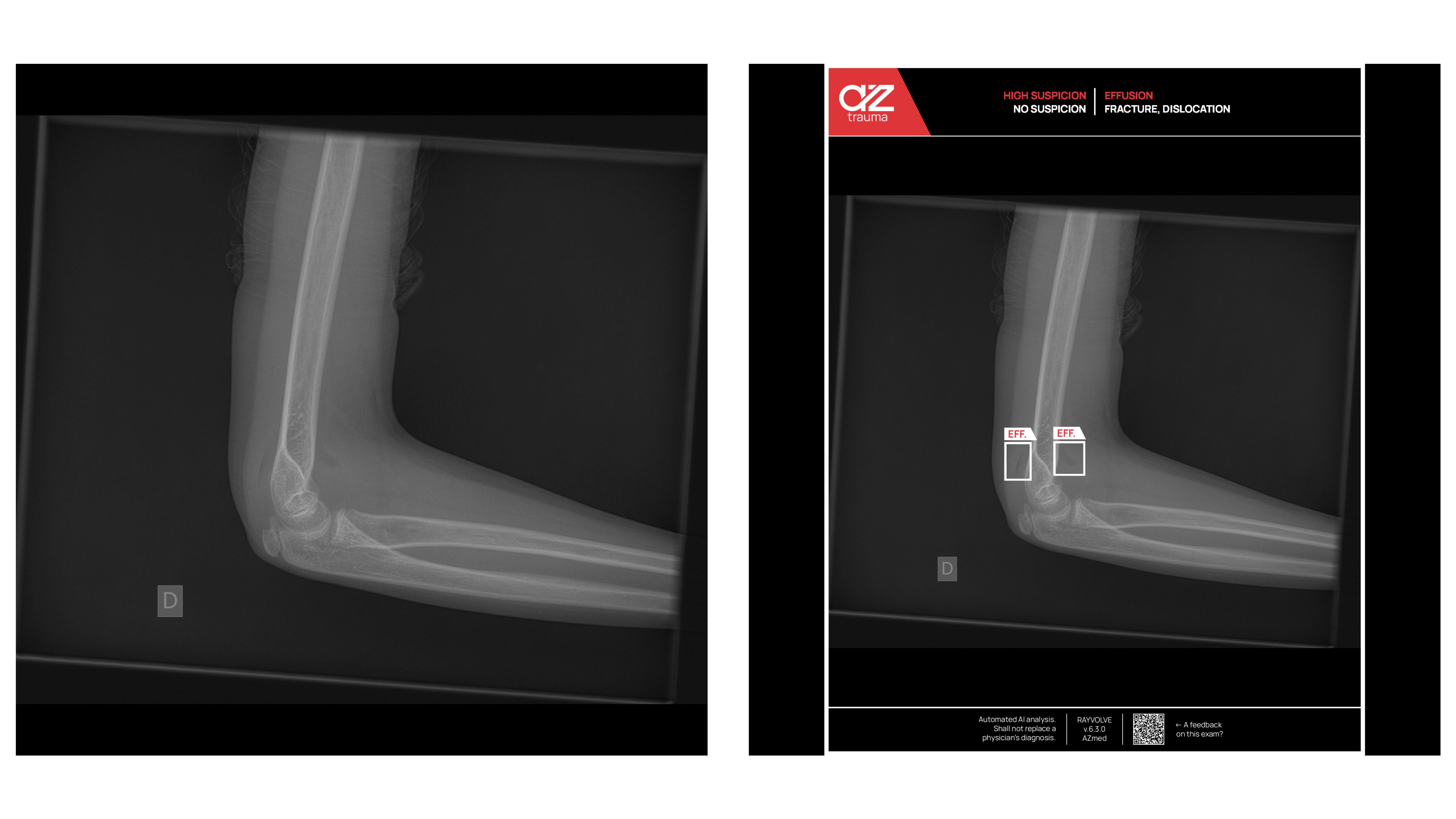 clinical case in fracture analysis with ai