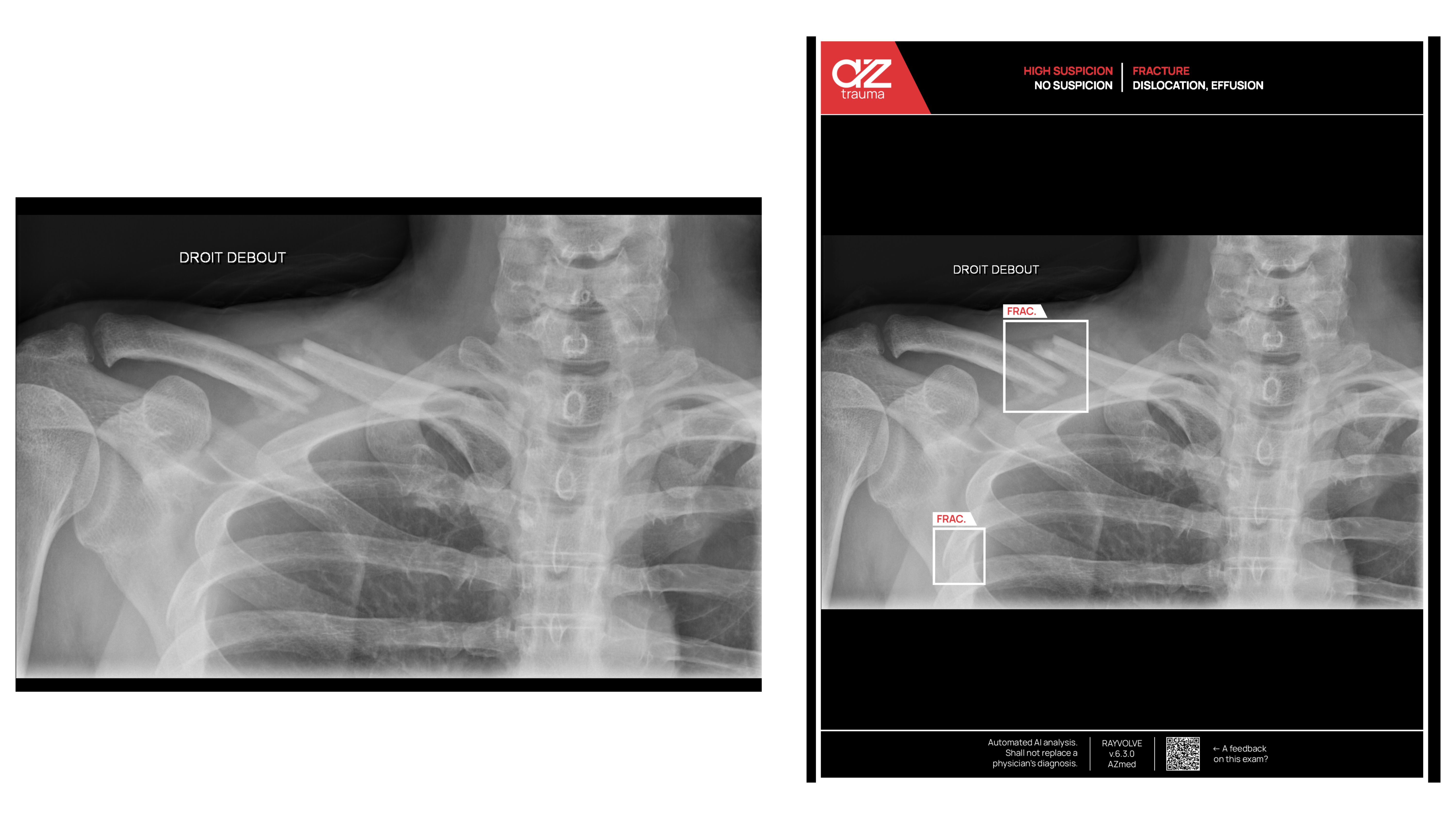 ai fracture with aztrauma