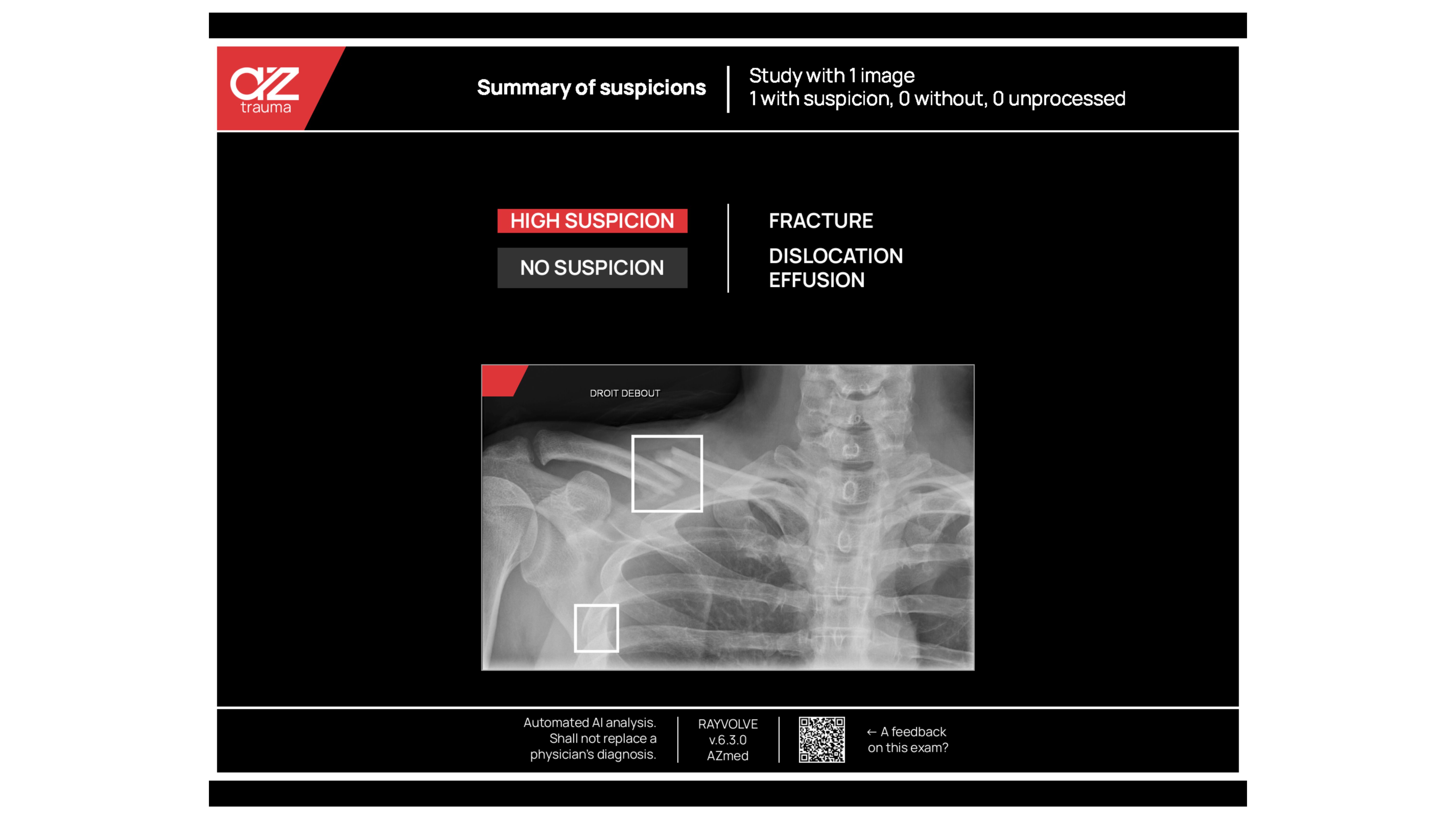 ai fracture summary with aztrauma