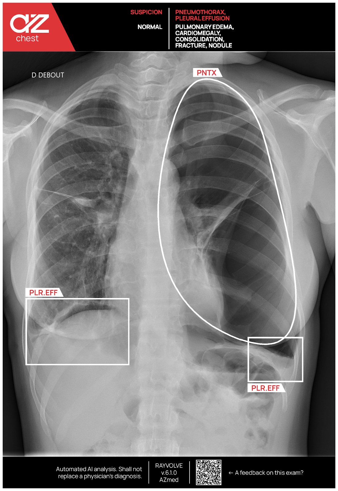 AI for Chest Detection in Radiology