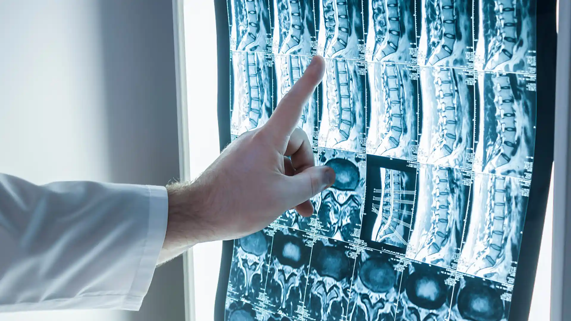 Spine MRI scans showing herniated disc back injury