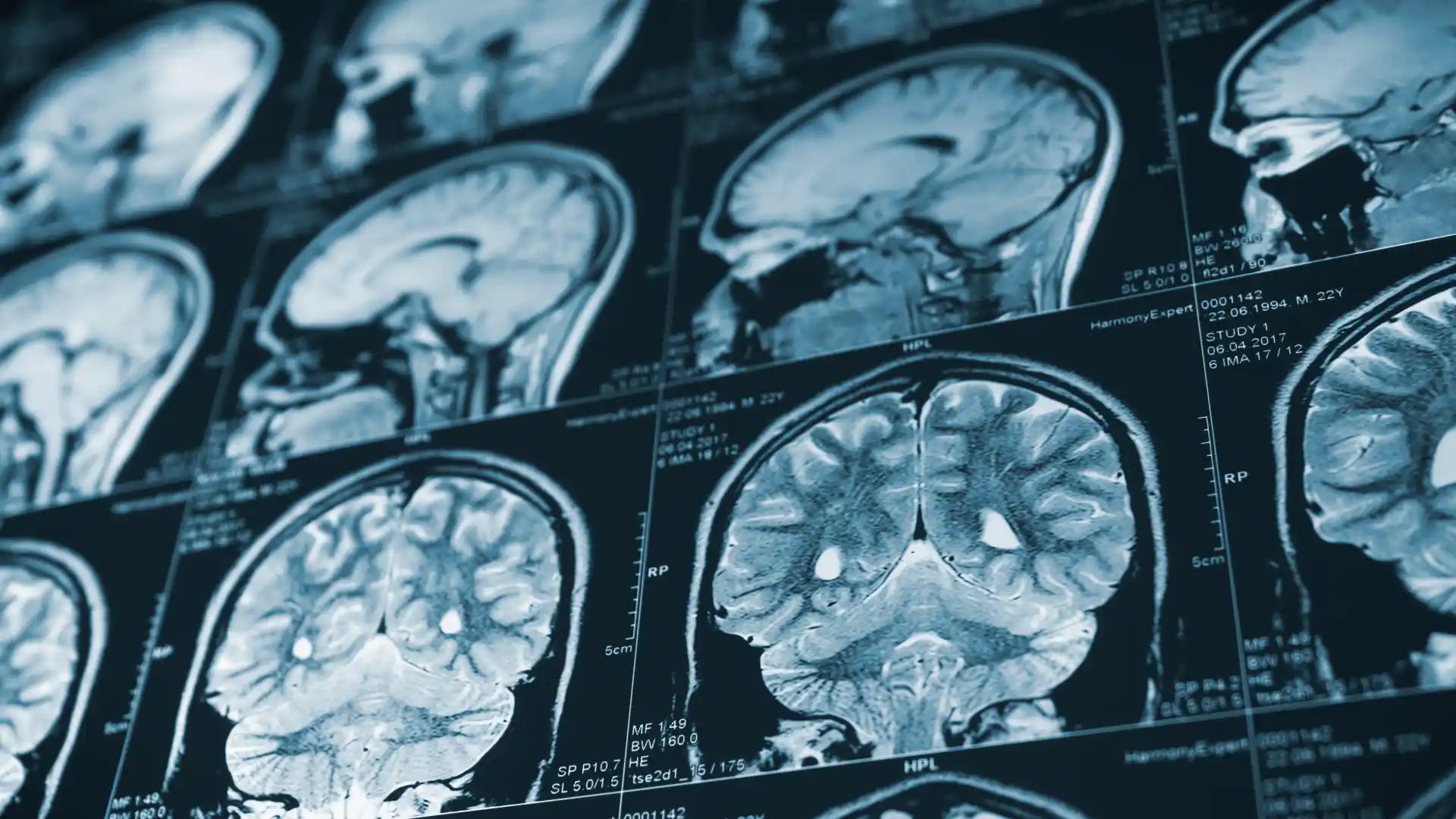 Brain scan images showing subtle changes to the brain after an injury over time