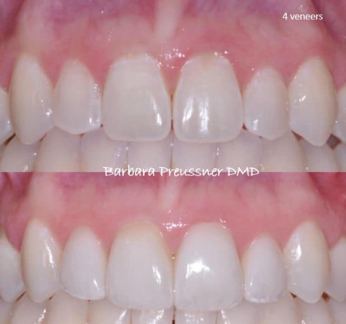 Before and after smile transformation showing porcelain veneers on front teeth