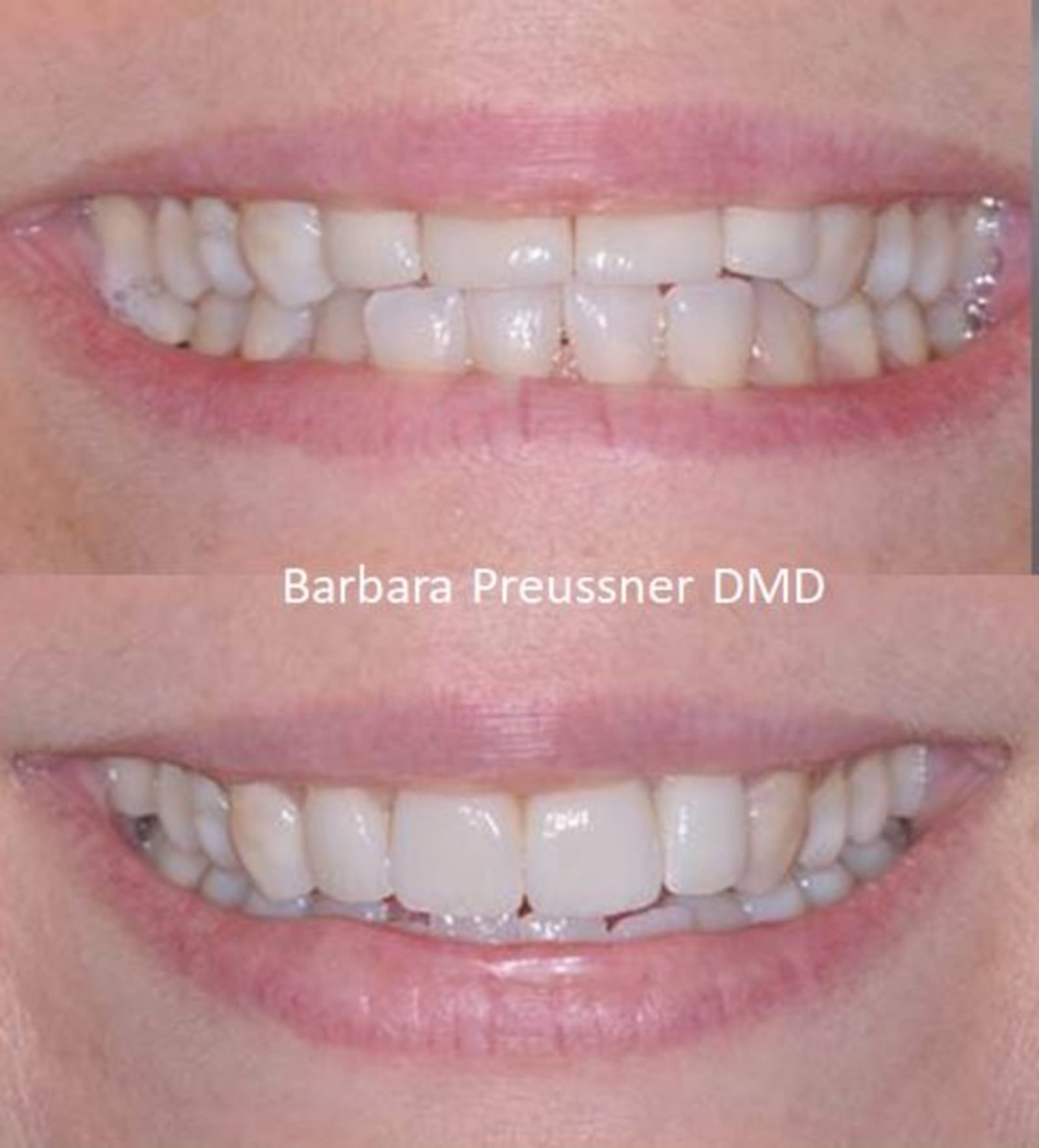 Before and after smile photos showing teeth straightening results