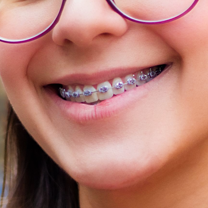 Jeune fille souriant largement avec un appareil dentaire à plaquettes.