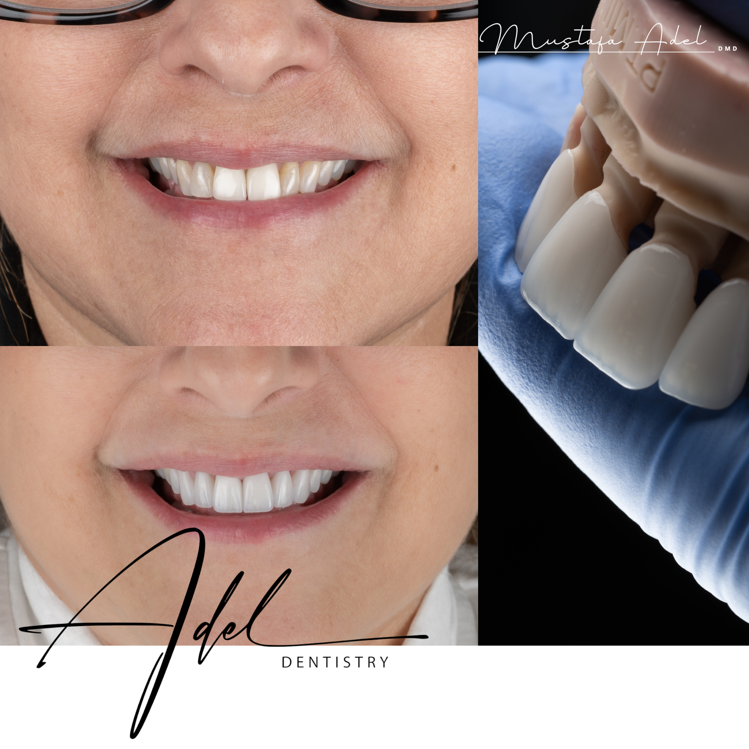 Porcelain Veneers Case - Adel Dentistry Tampa FL