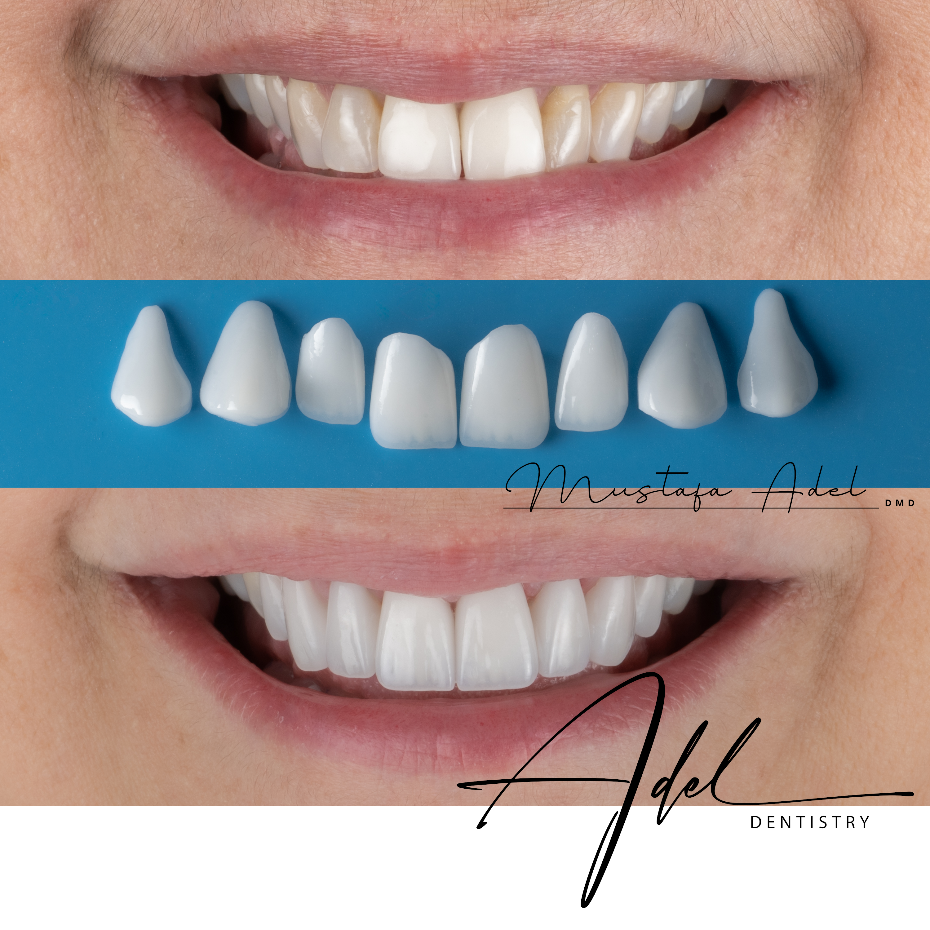 Porcelain Veneers Before and After Tampa FL - Adel Dentistry