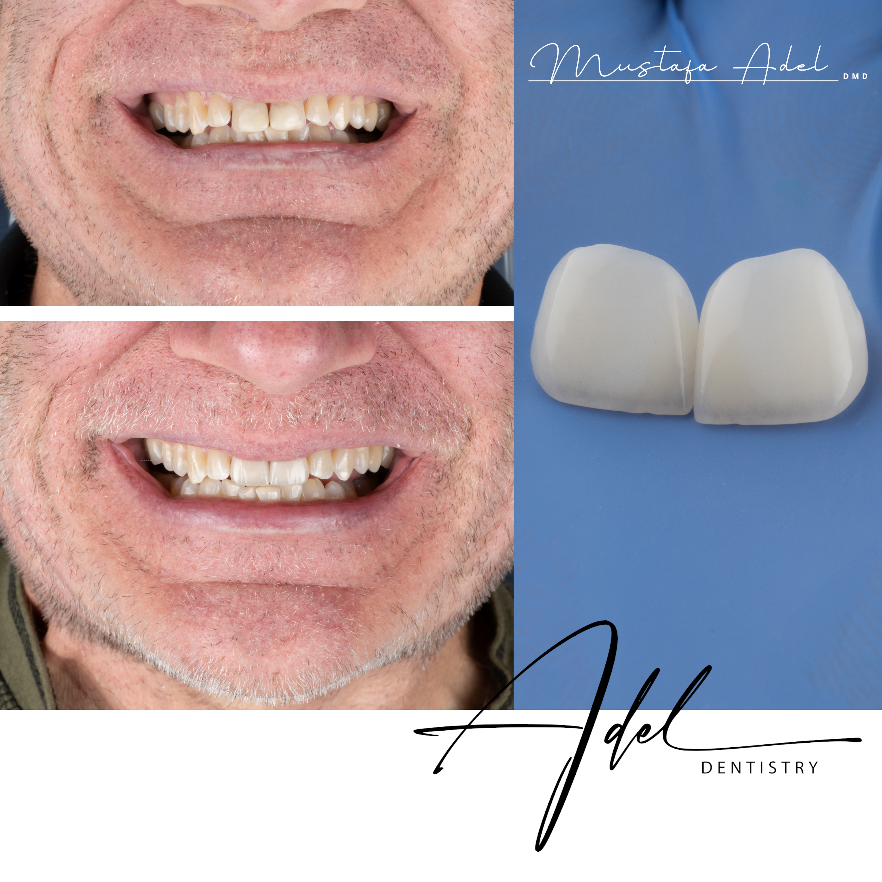 Doug Smile Case - Adel Dentistry Tampa FL