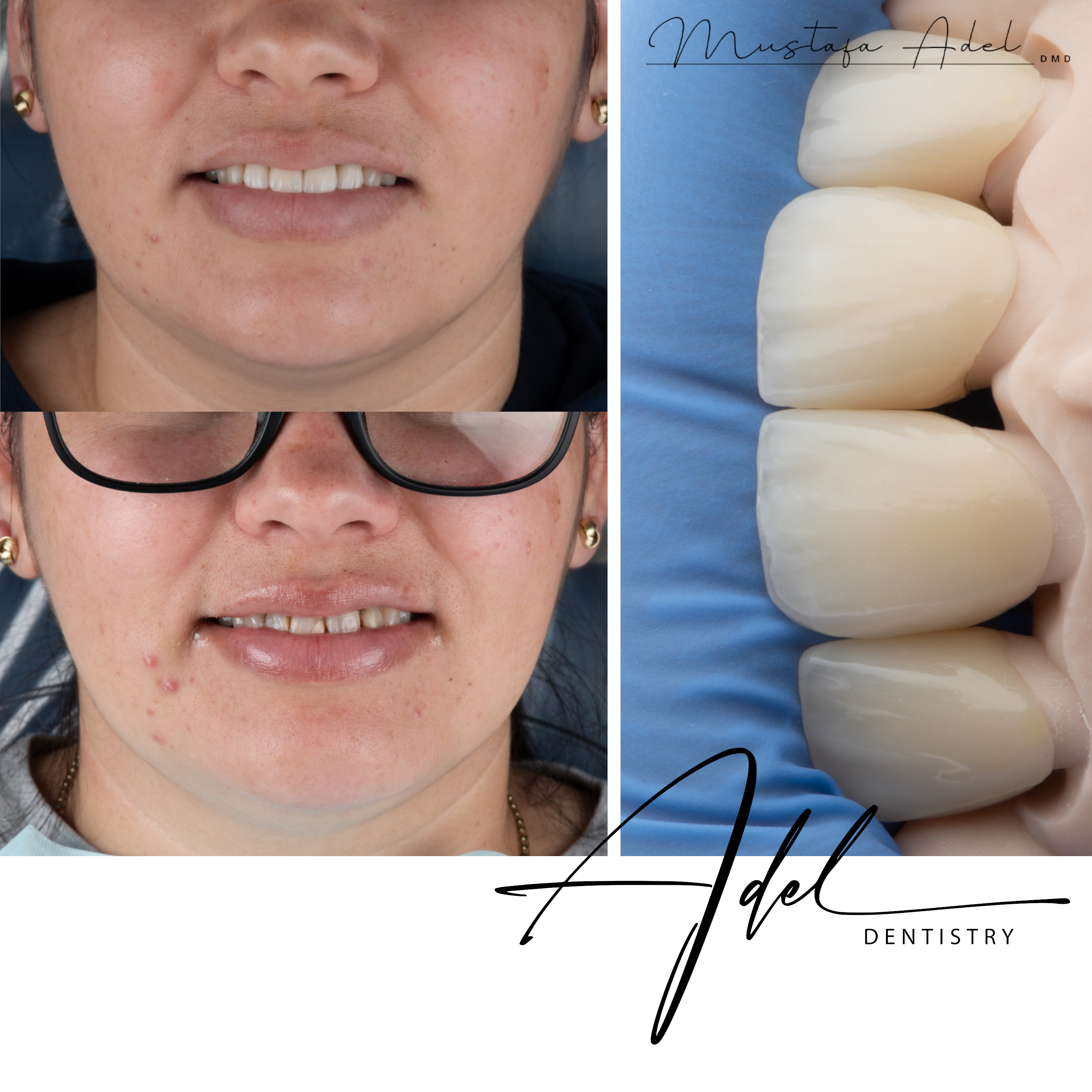 Anterior 4 Veneers Case - Adel Dentistry Tampa FL