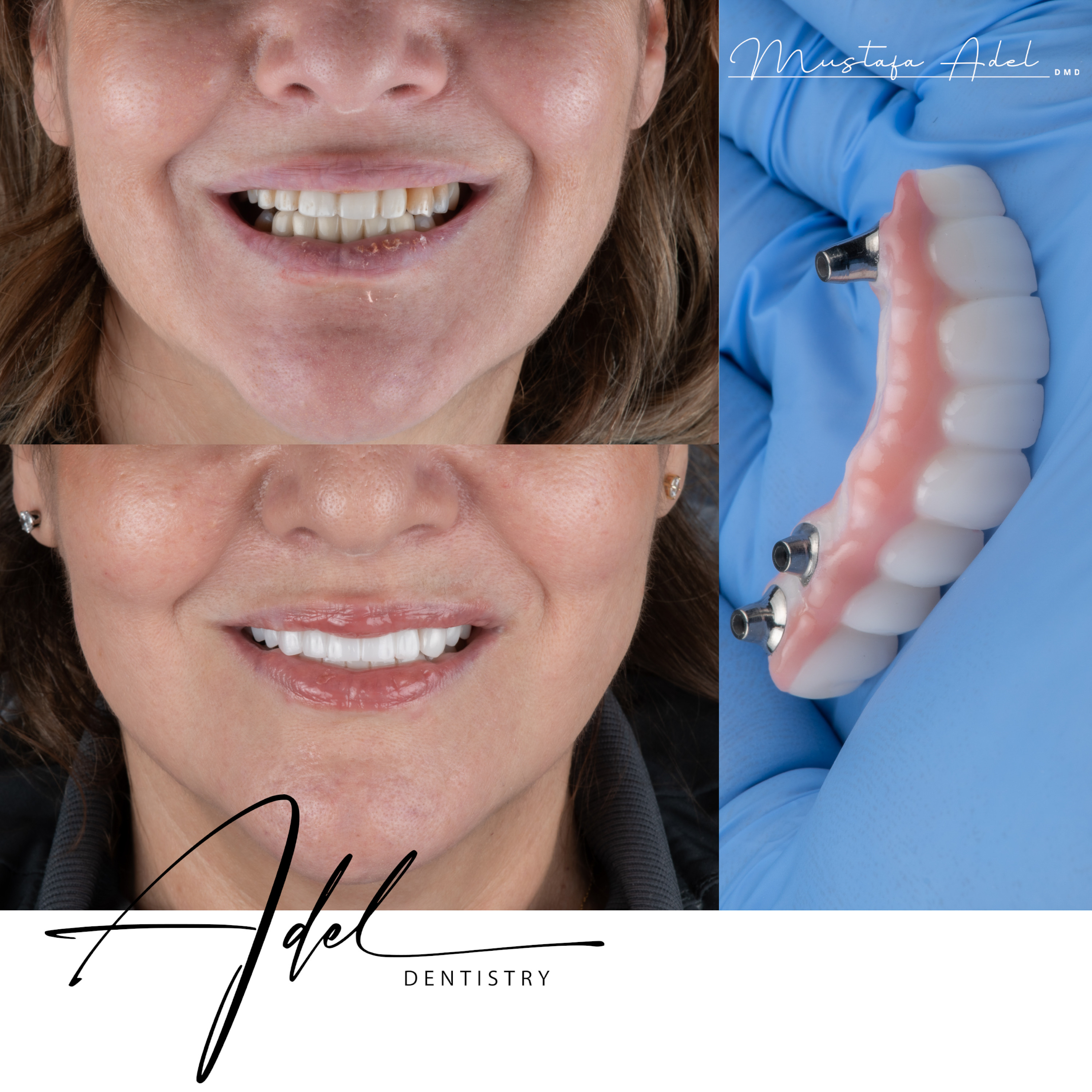 Implant Supported Veneers - Adel Dentistry Tampa FL