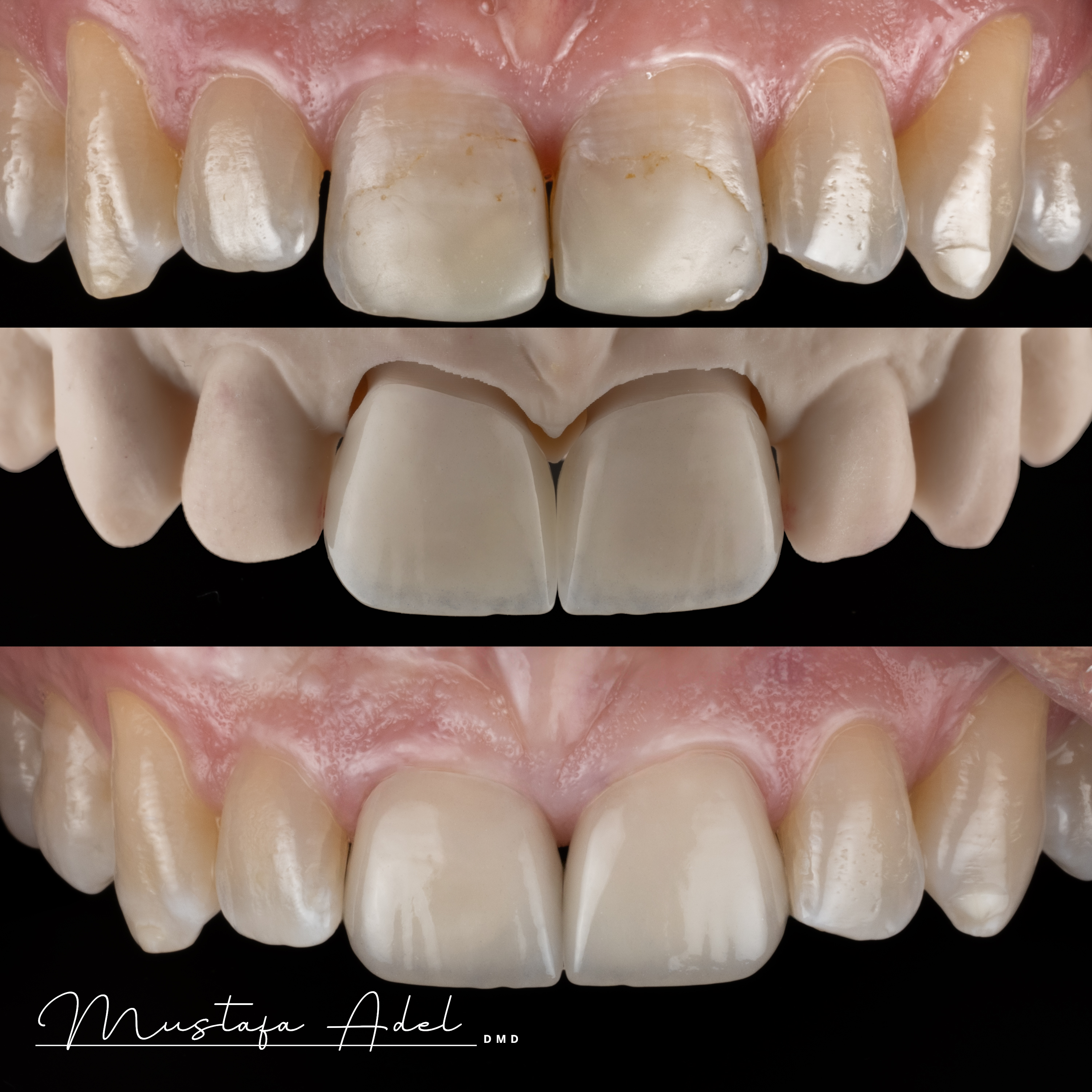 Doug Before After - Adel Dentistry Tampa FL