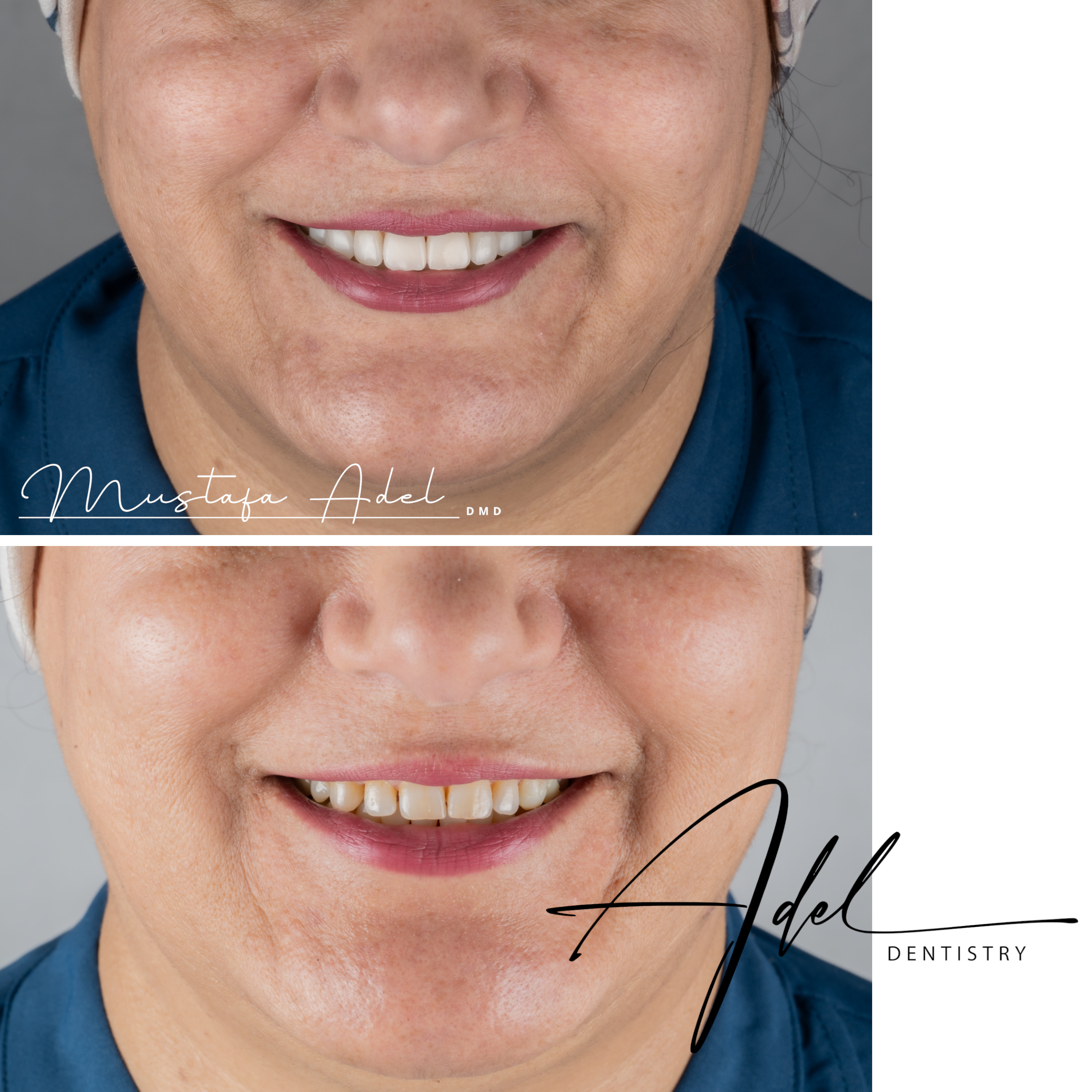 No Prep Veneers 2 - Adel Dentistry Tampa FL