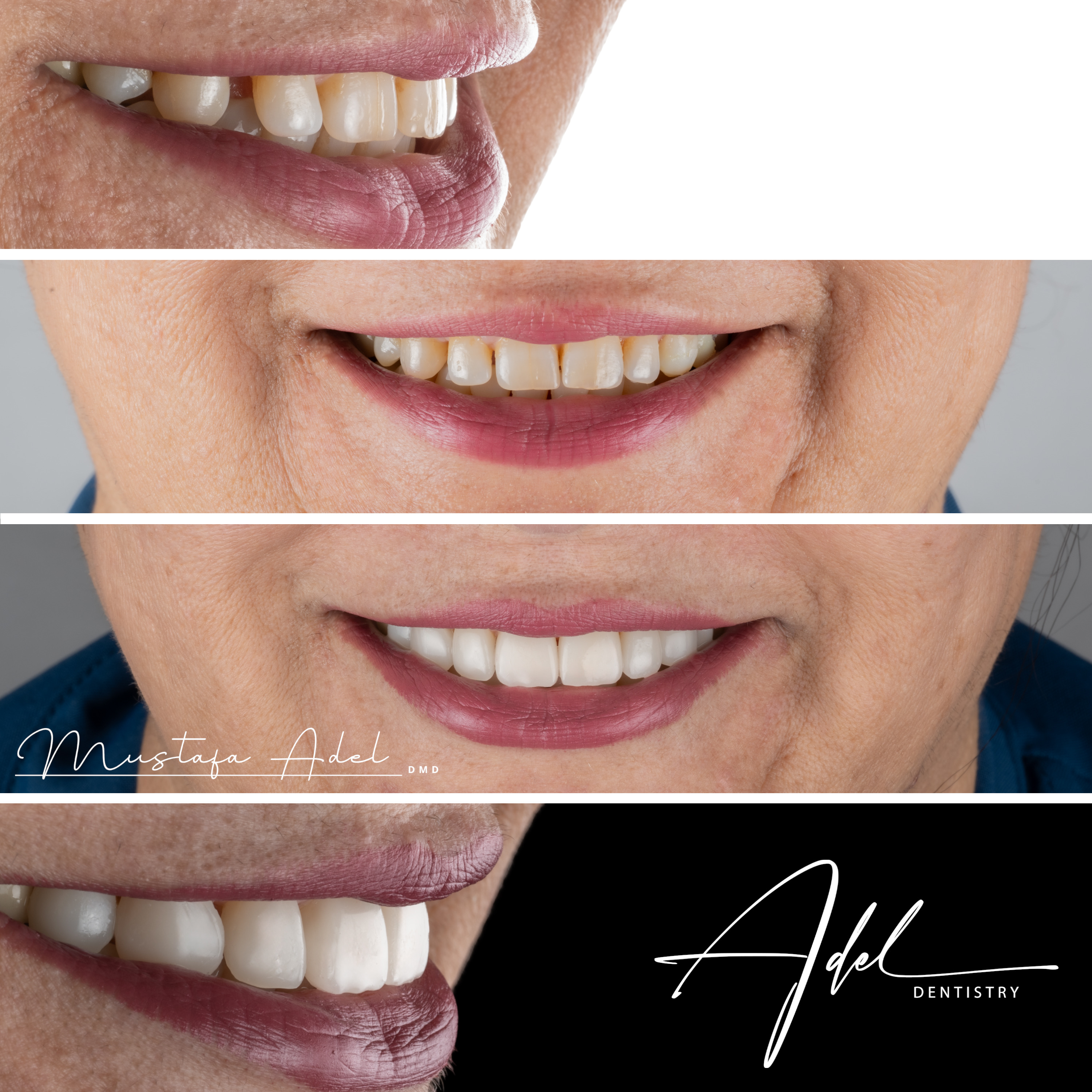 No Prep Veneers - Adel Dentistry Tampa FL