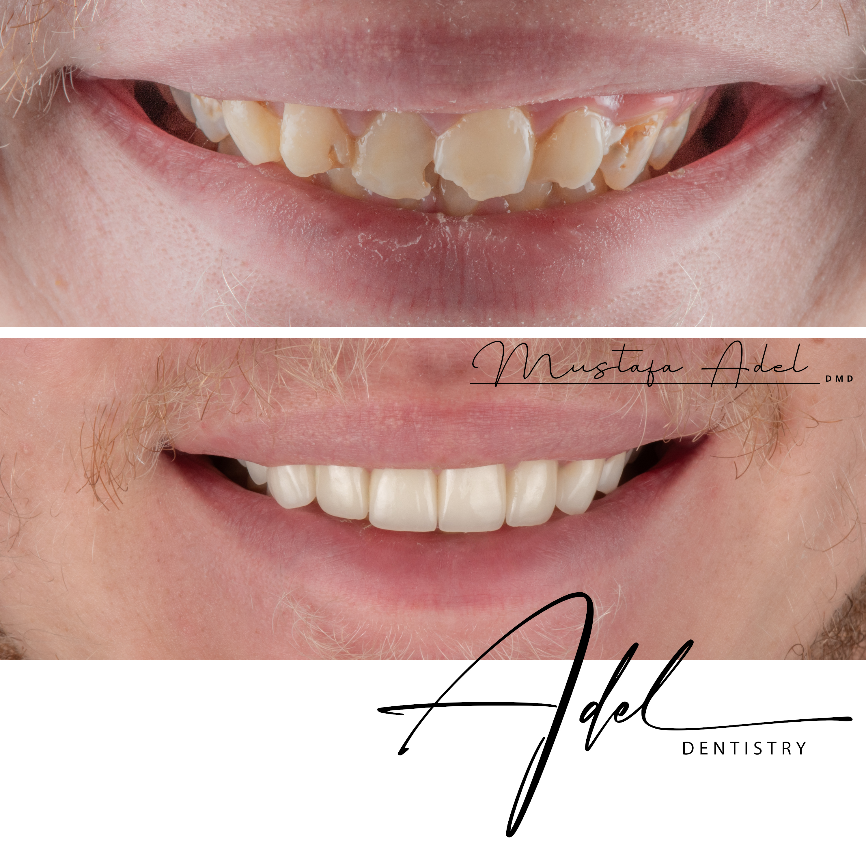 Teen Smile Transformation - Adel Dentistry Tampa FL