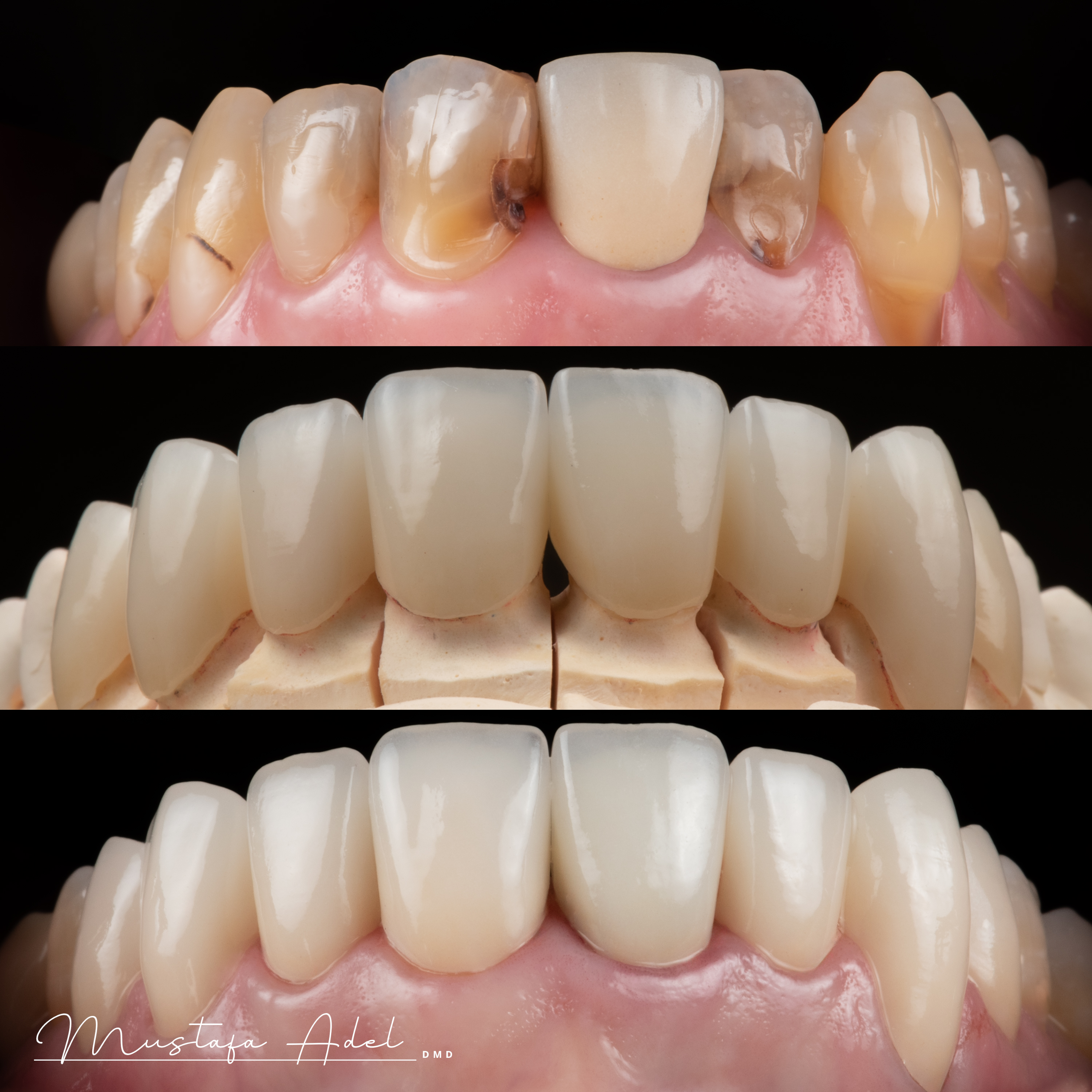 Wedding Smile Case 2 - Adel Dentistry Tampa FL