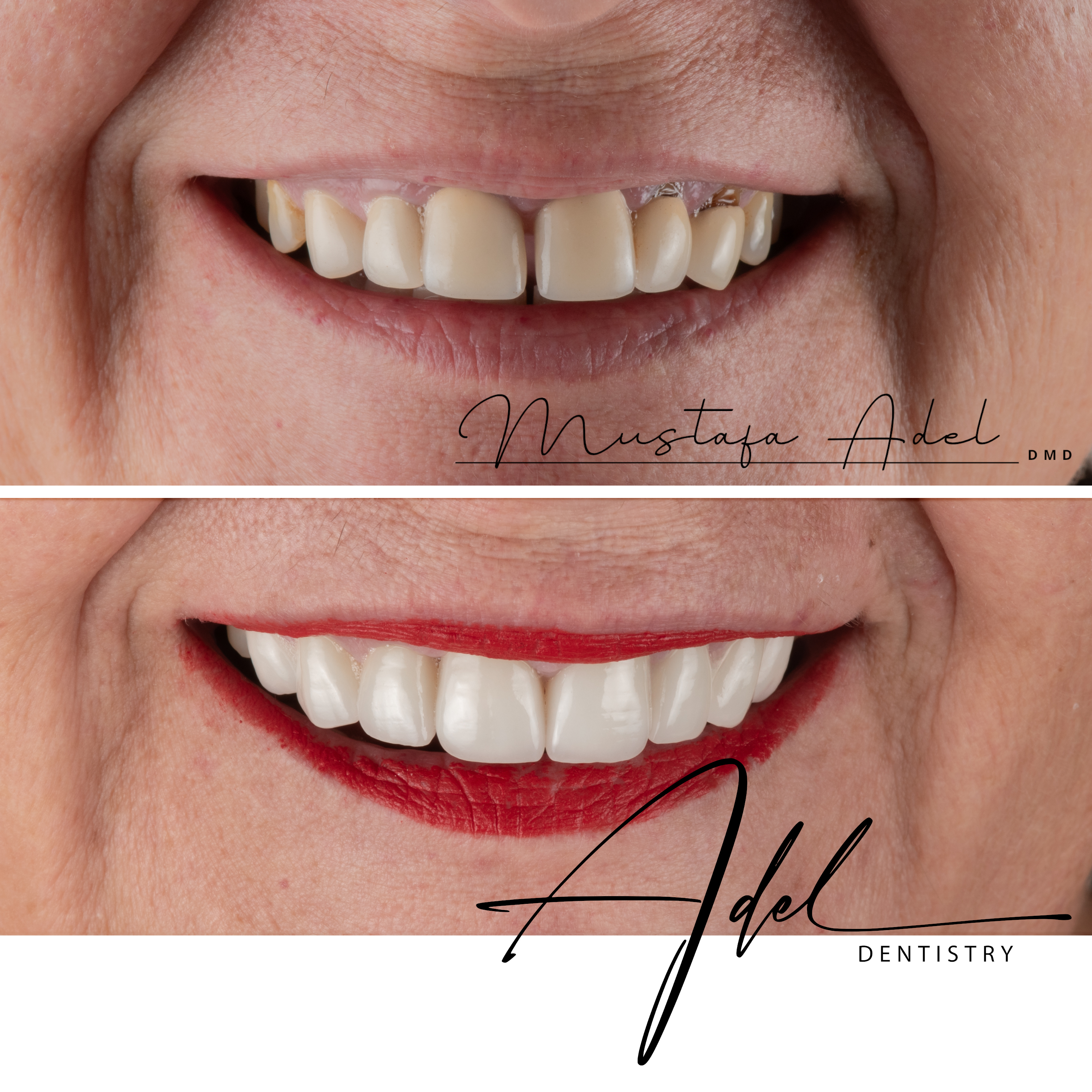 Dog Lady Smile Transformation - Adel Dentistry Tampa FL