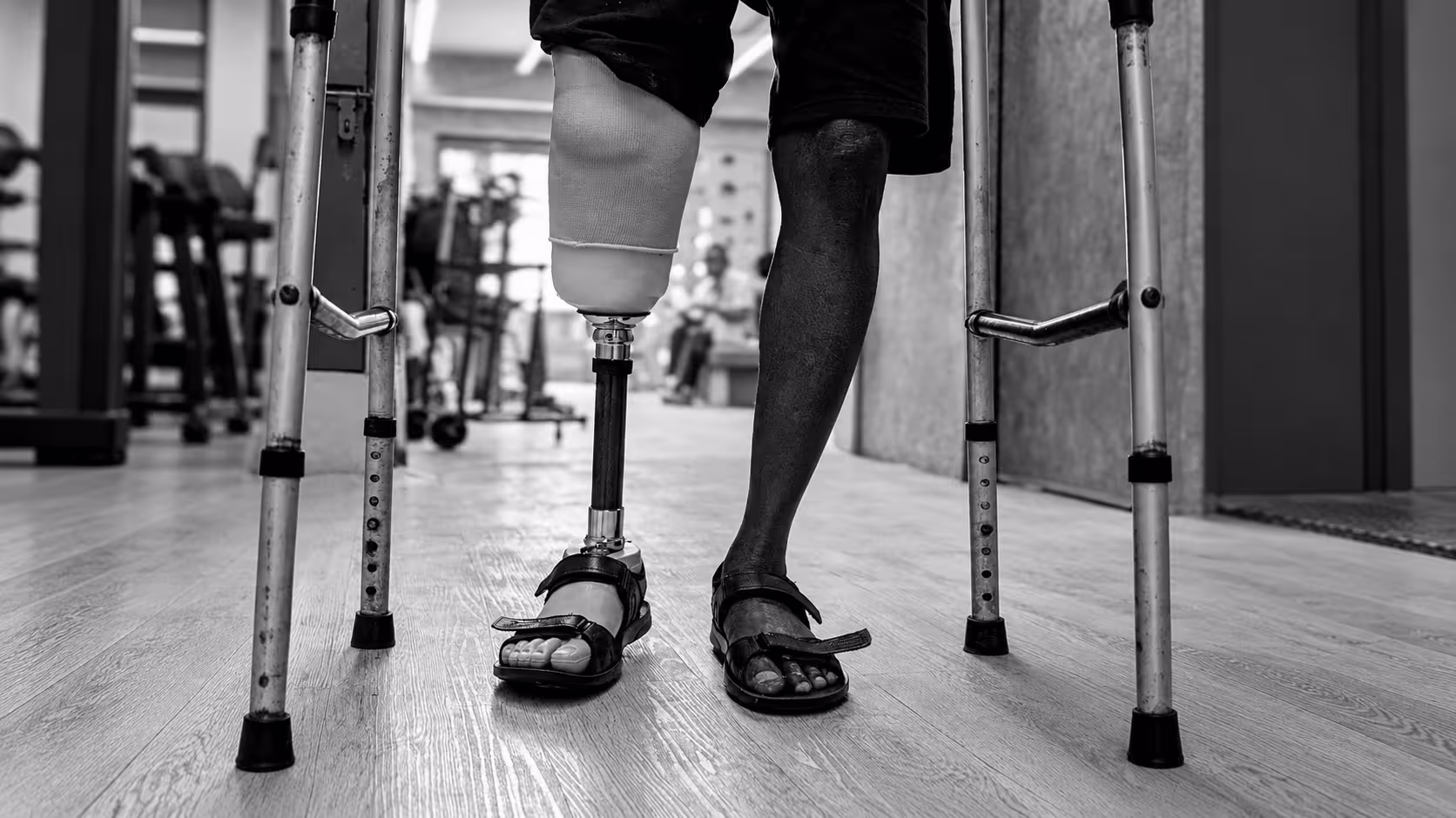 A patient of Rise Bionics wearing a definitive prosthesis to walk and move around comfortably