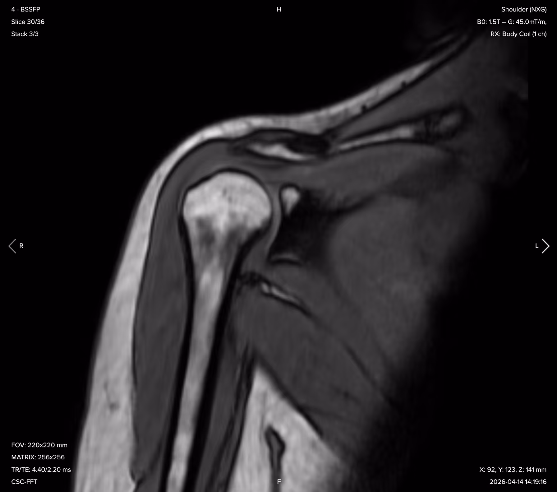 Corsmed’s Image Viewer tool, displaying a coronal view of a shoulder scan.