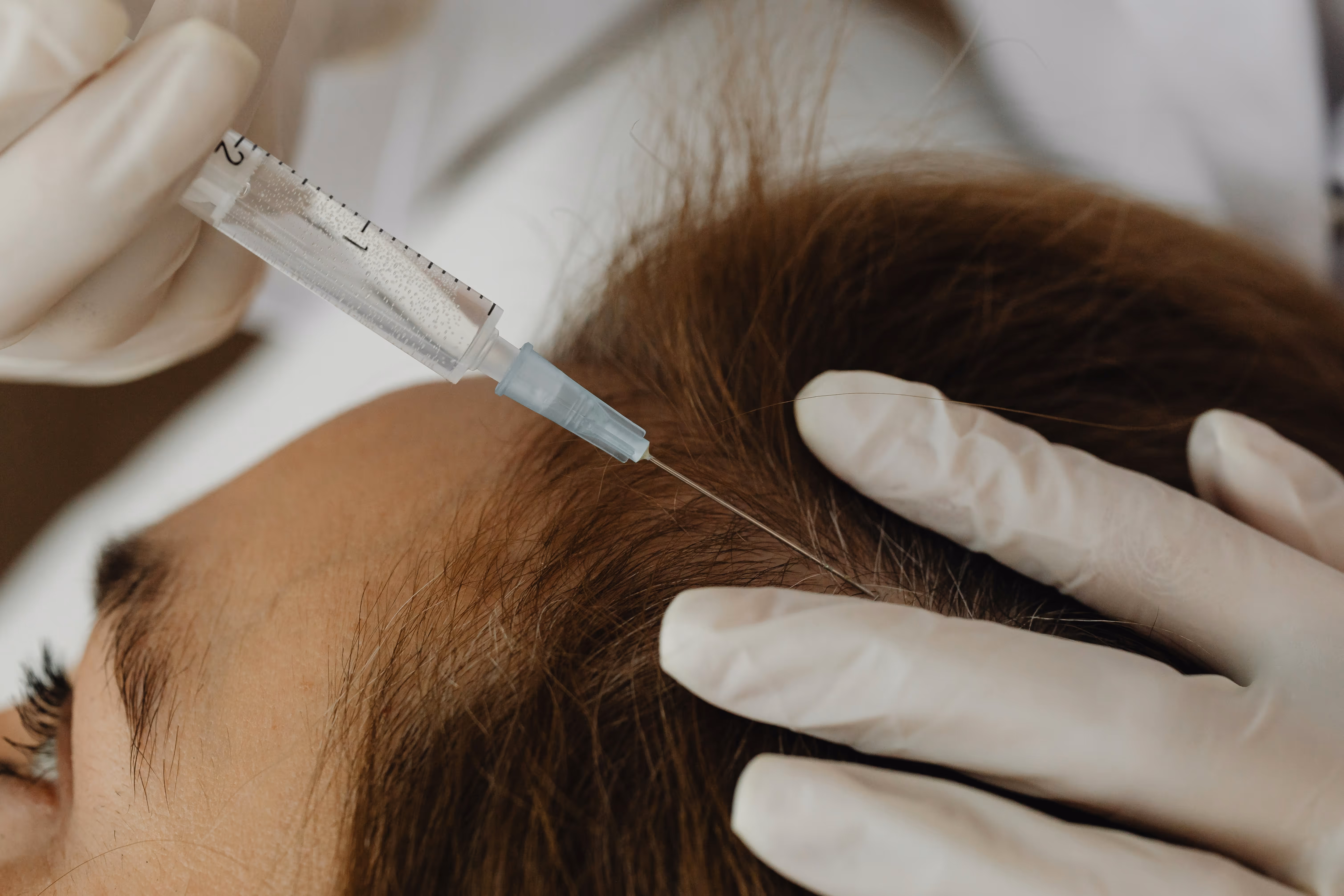 Professionnel réalisant une injection capillaire sur un cuir chevelu. Procédure pour la gestion de l'alopécie en France.