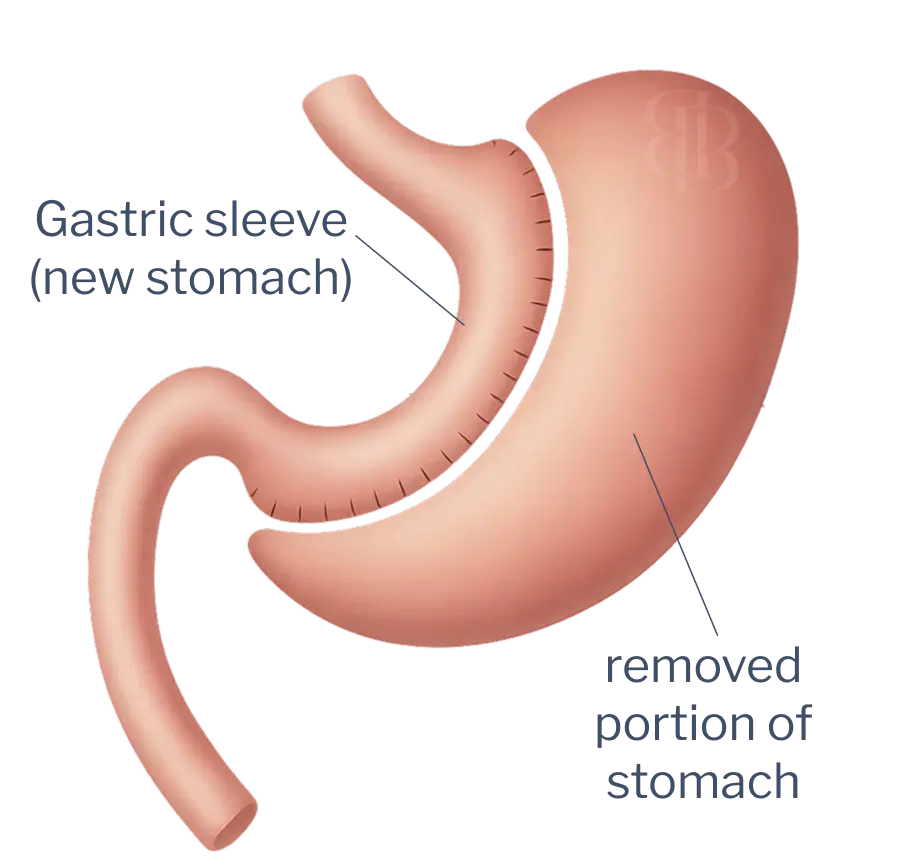 Graphic of a gastric sleeve surgery showing the newly created stomach and the removed portion of the original stomach.