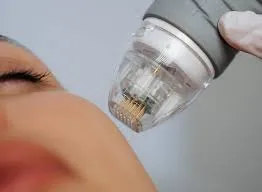 Why Vivace Is the Top Choice for Microneedling in Larnaca, Cyprus