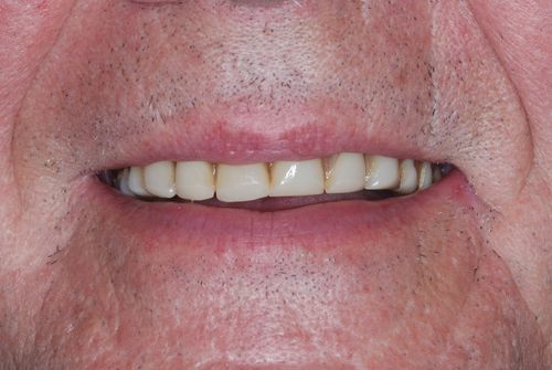 Patients teeth before fitting