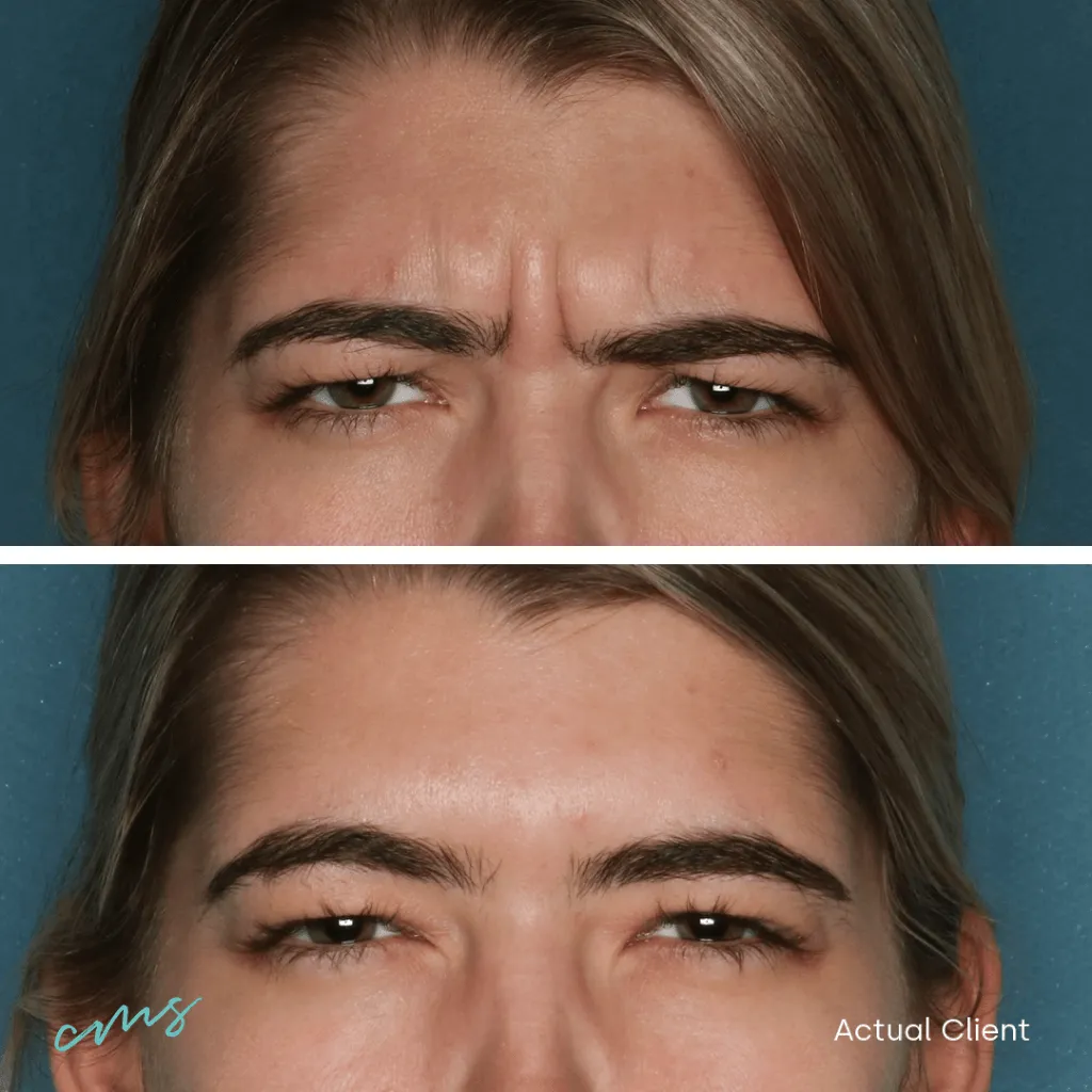 Before and after Botox treatment on the wrinkles between the eyes