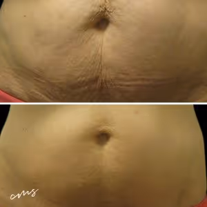 Before and after Vanquish treatment on the waist area