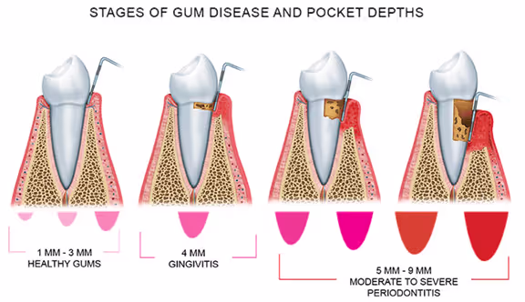 Gum disease illustration